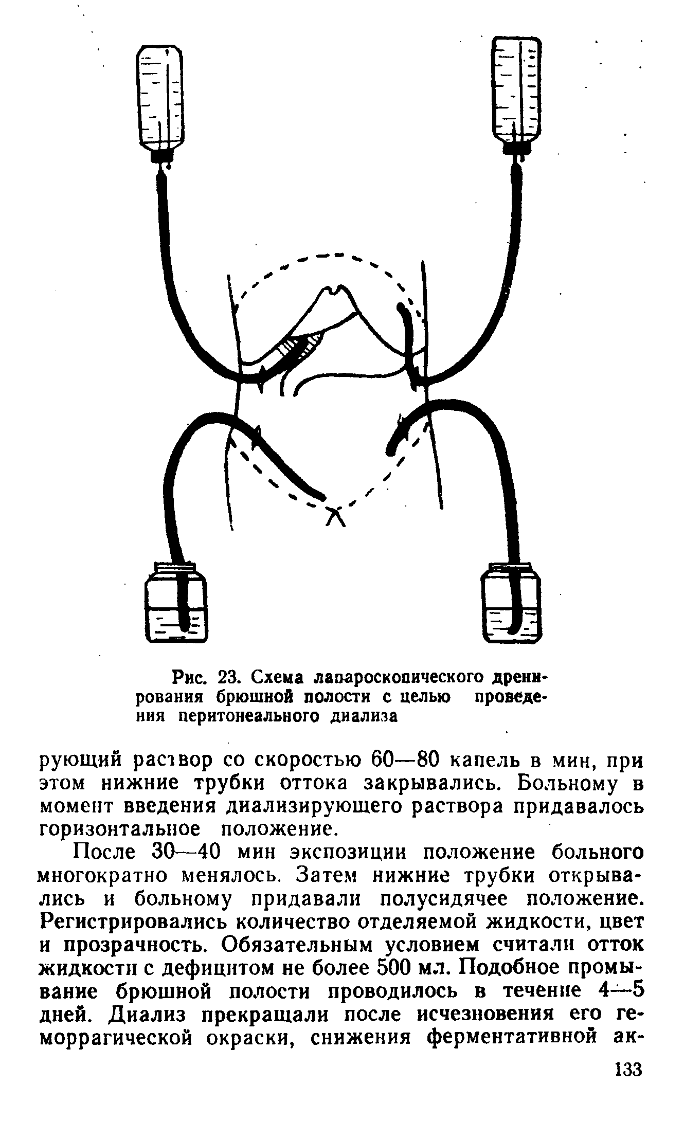 Рис. 23. Схема лапароскопического дренирования брюшной полости с целью проведения перитонеального диализа...