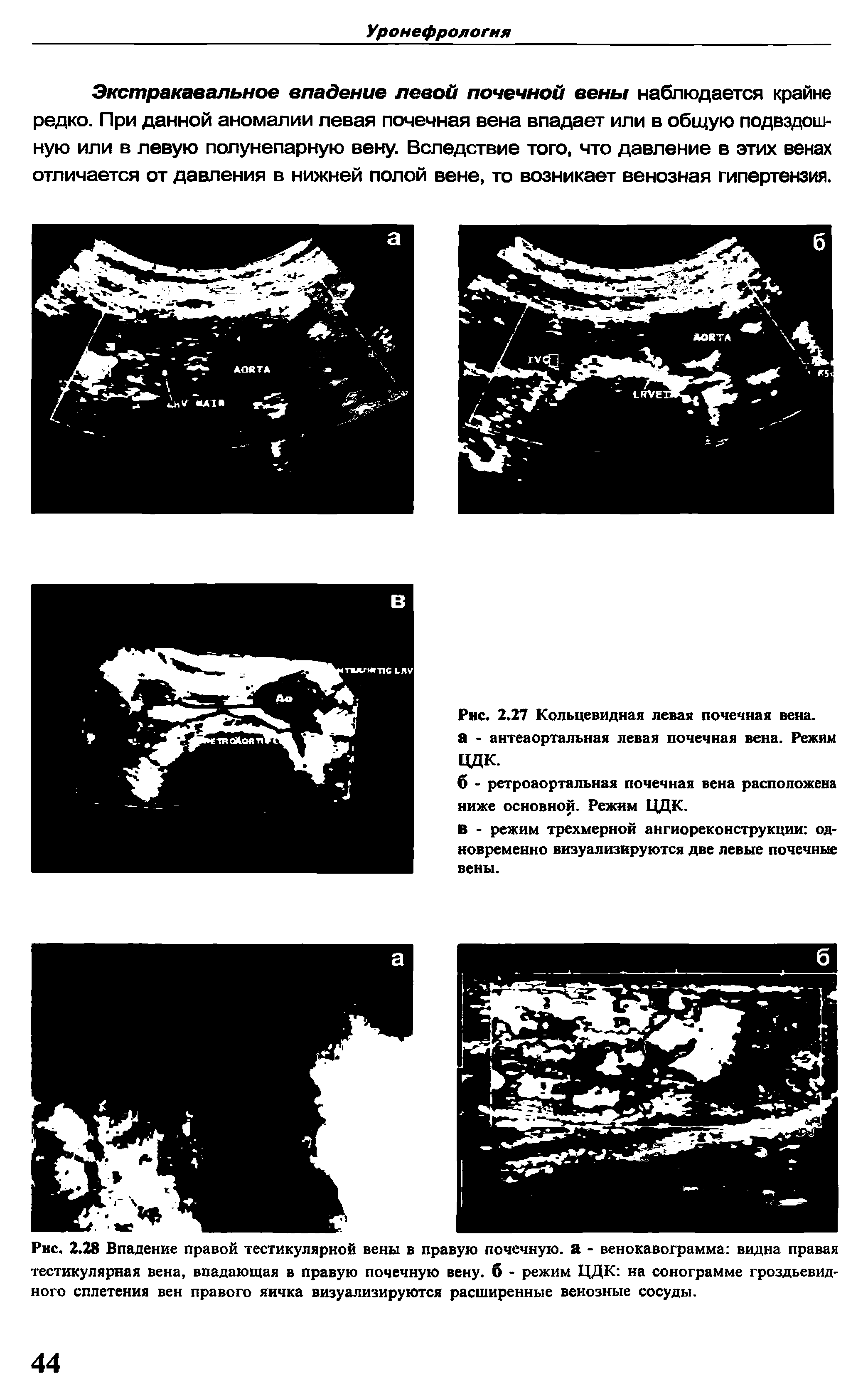 Рис. 2.27 Кольцевидная левая почечная вена, а - антеаортальная левая почечная вена. Режим цдк.