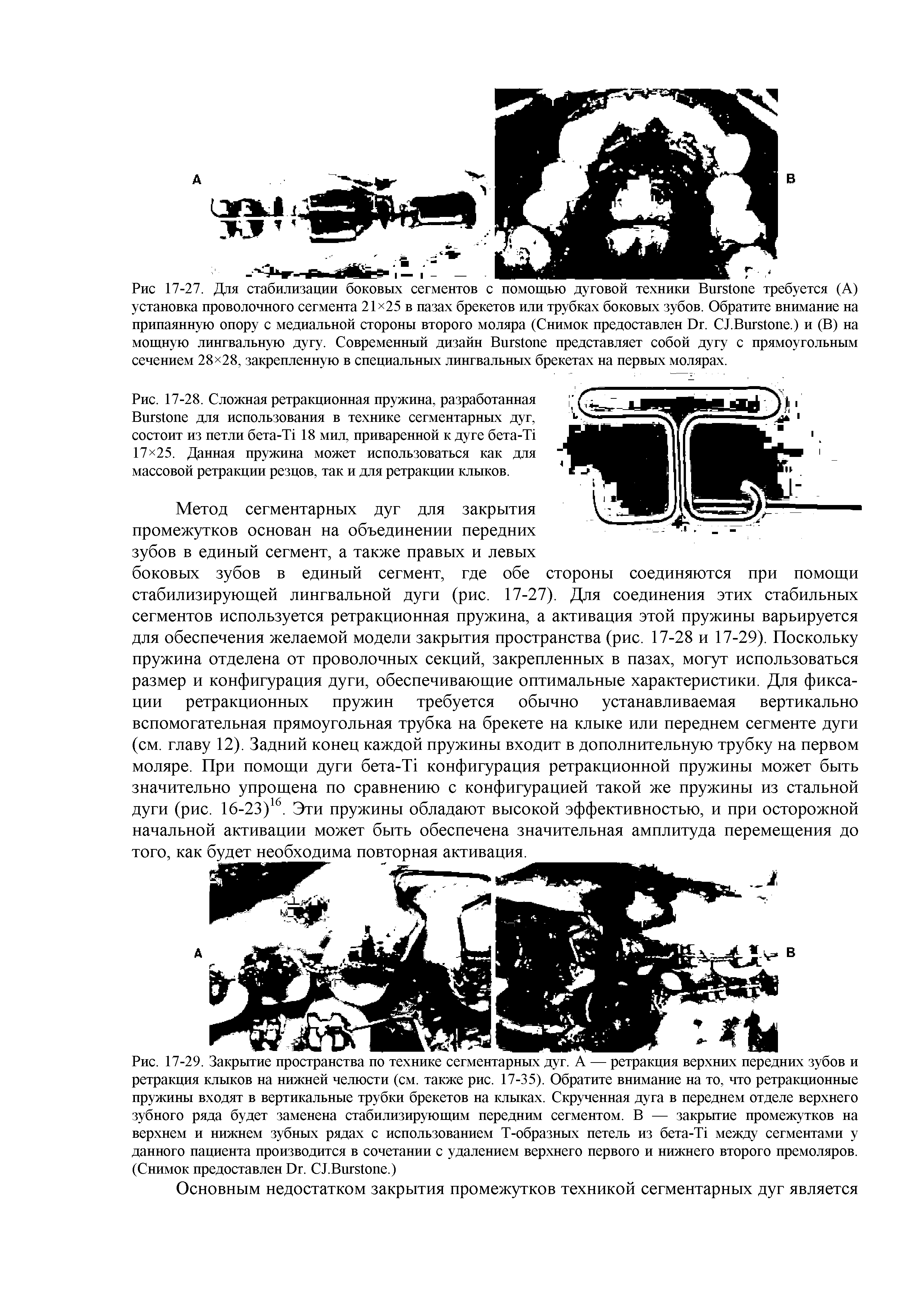 Рис. 17-28. Сложная ретракционная пружина, разработанная ВигеЮпс для использования в технике сегментарных дуг, состоит из петли бета-Тл 18 мил, приваренной к дуге бета-11 17 25. Данная пружина может использоваться как для массовой ретракции резцов, так и для ретракции клыков.