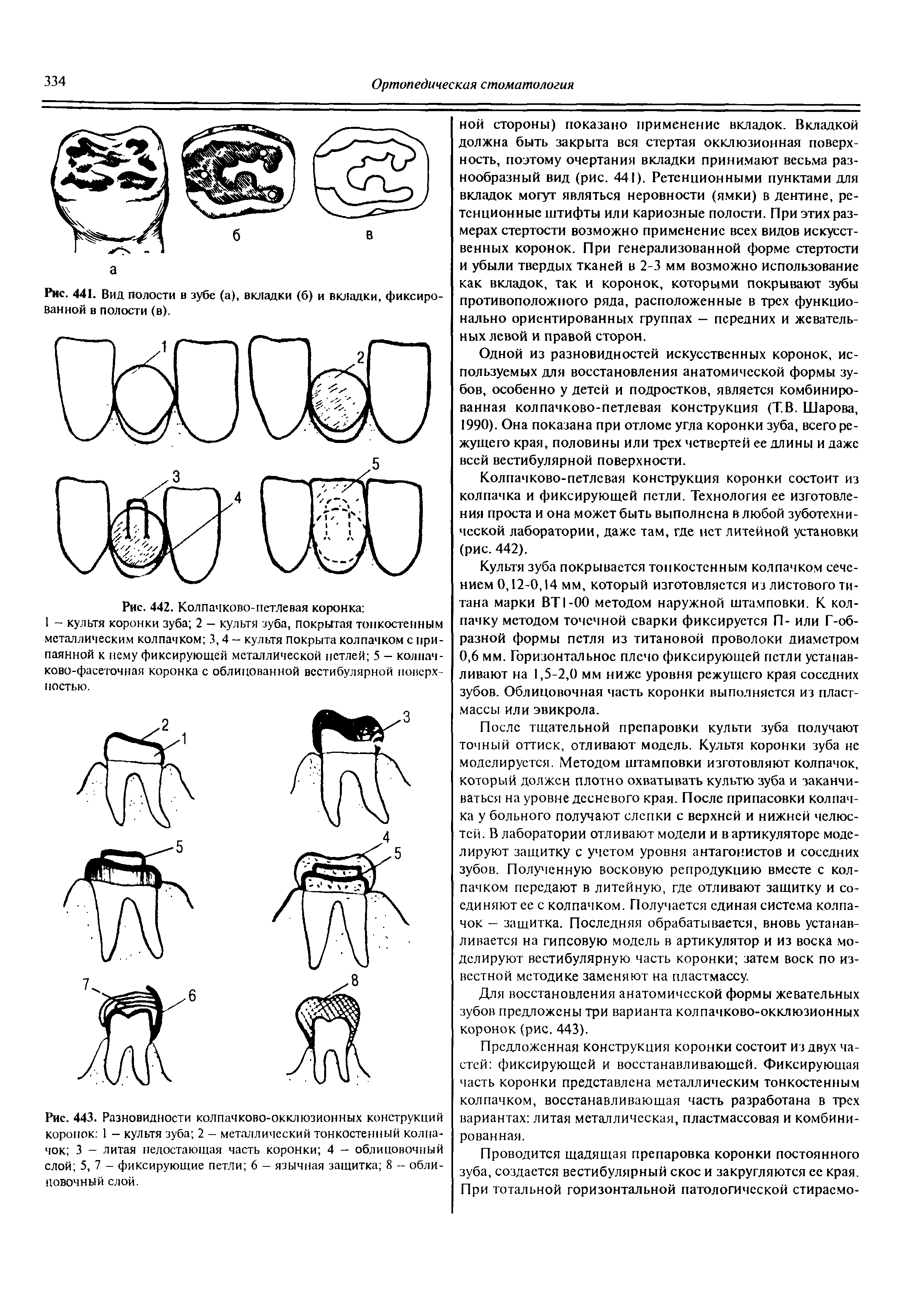 Рис. 443. Разновидности колпачково-окклюзионных конструкций коронок 1 - культя зуба 2 — металлический тонкостенный колпачок 3 - литая недостающая часть коронки 4 - облицовочный слой 5, 7 - фиксирующие петли 6 — язычная защитна 8 - облицовочный слой.