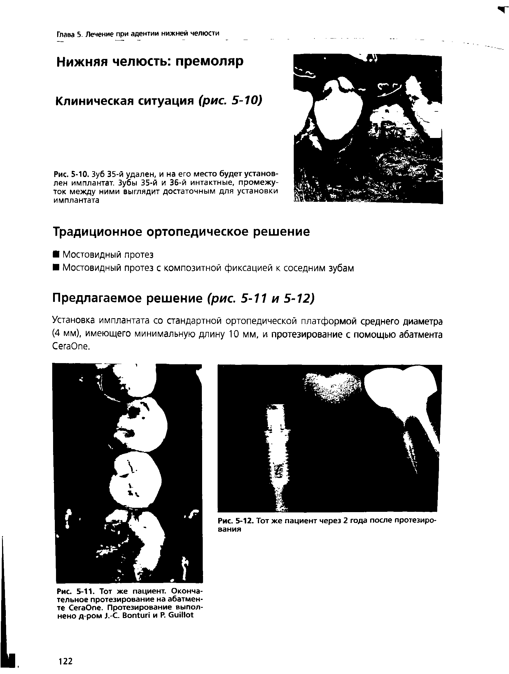 Рис. 5-10. Зуб 35-й удален, и на его место будет установлен имплантат. Зубы 35-й и Зб-й интактные, промежуток между ними выглядит достаточным для установки имплантата...