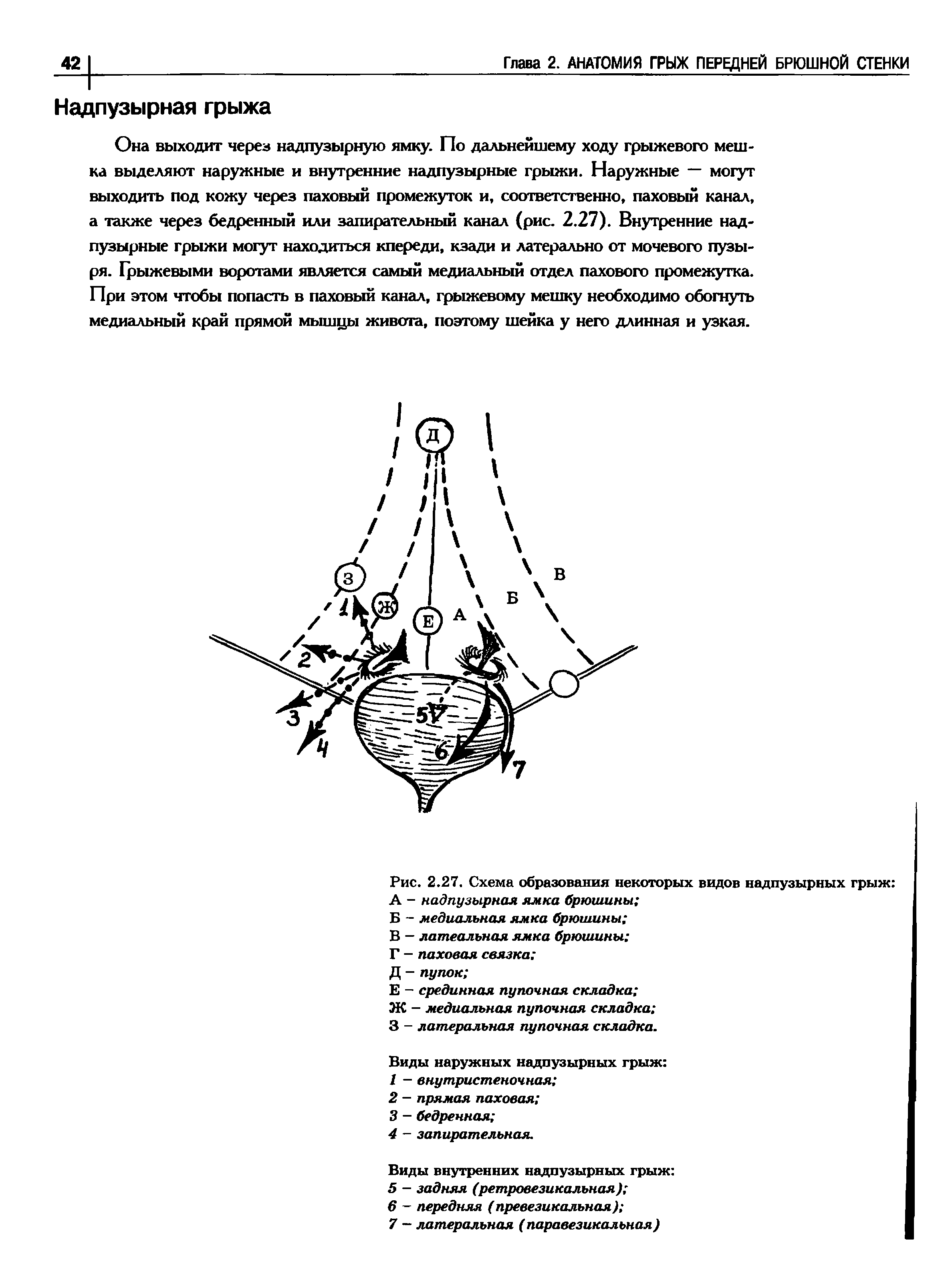 Рис. 2.27. Схема образования некоторых видов надпузырных грыж А - надпузырная ямка брюшины ...