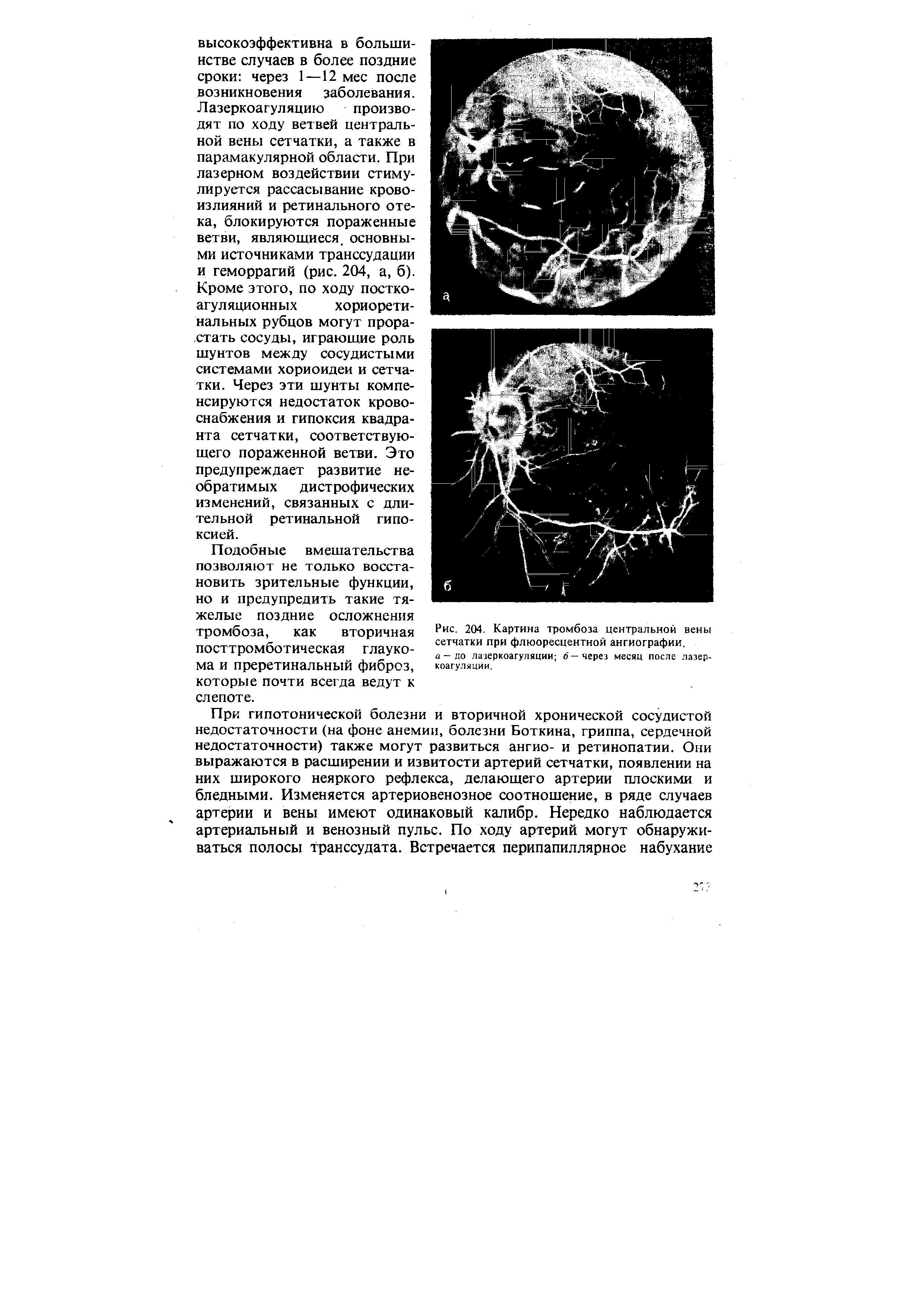 Рис. 204. Картина тромбоза центральной вены сетчатки при флюоресцентной ангиографии.