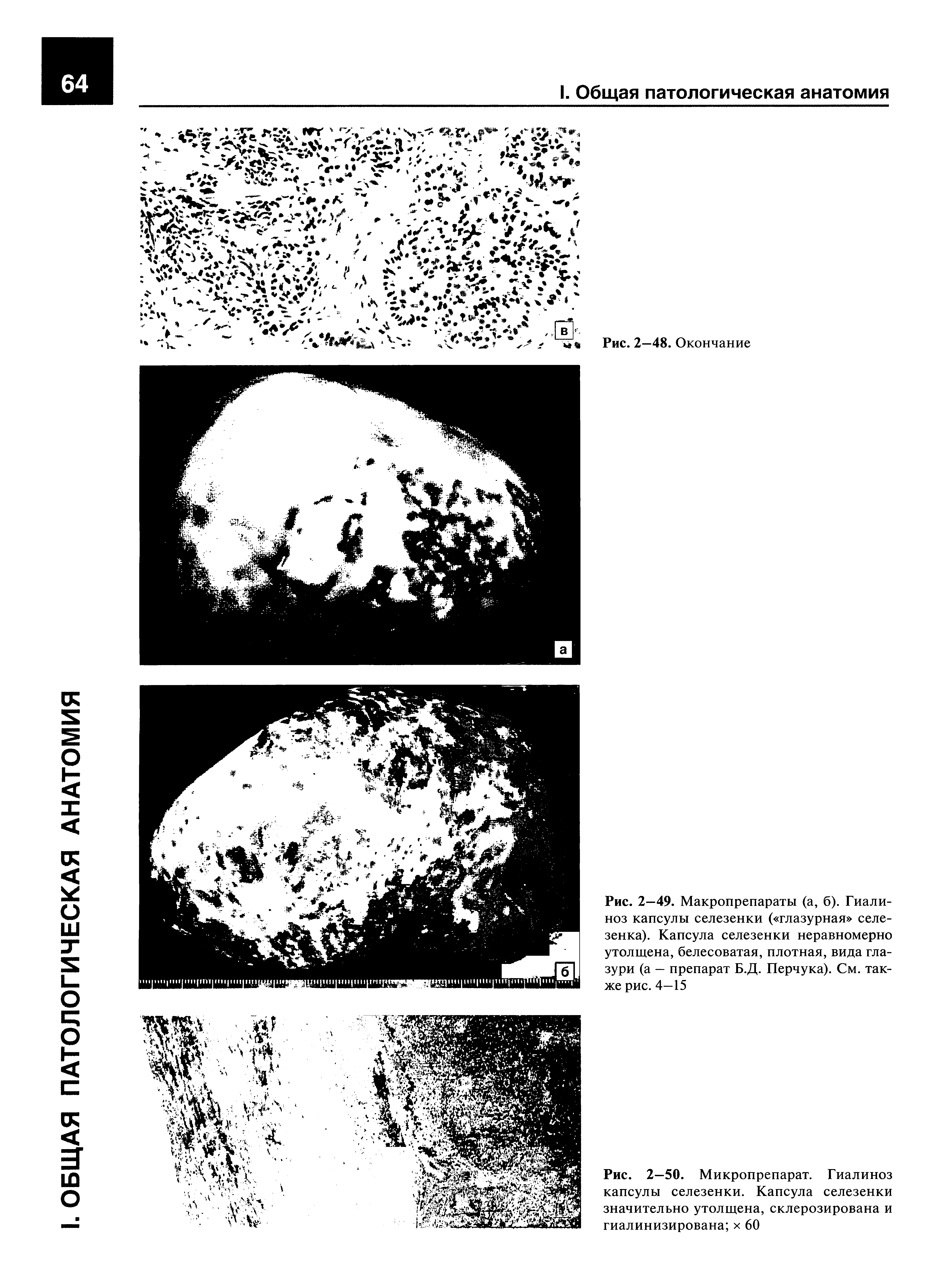 Рис. 2—49. Макропрепараты (а, б). Гиали-ноз капсулы селезенки ( глазурная селезенка). Капсула селезенки неравномерно утолщена, белесоватая, плотная, вида глазури (а — препарат Б.Д. Перчука). См. также рис. 4—15...