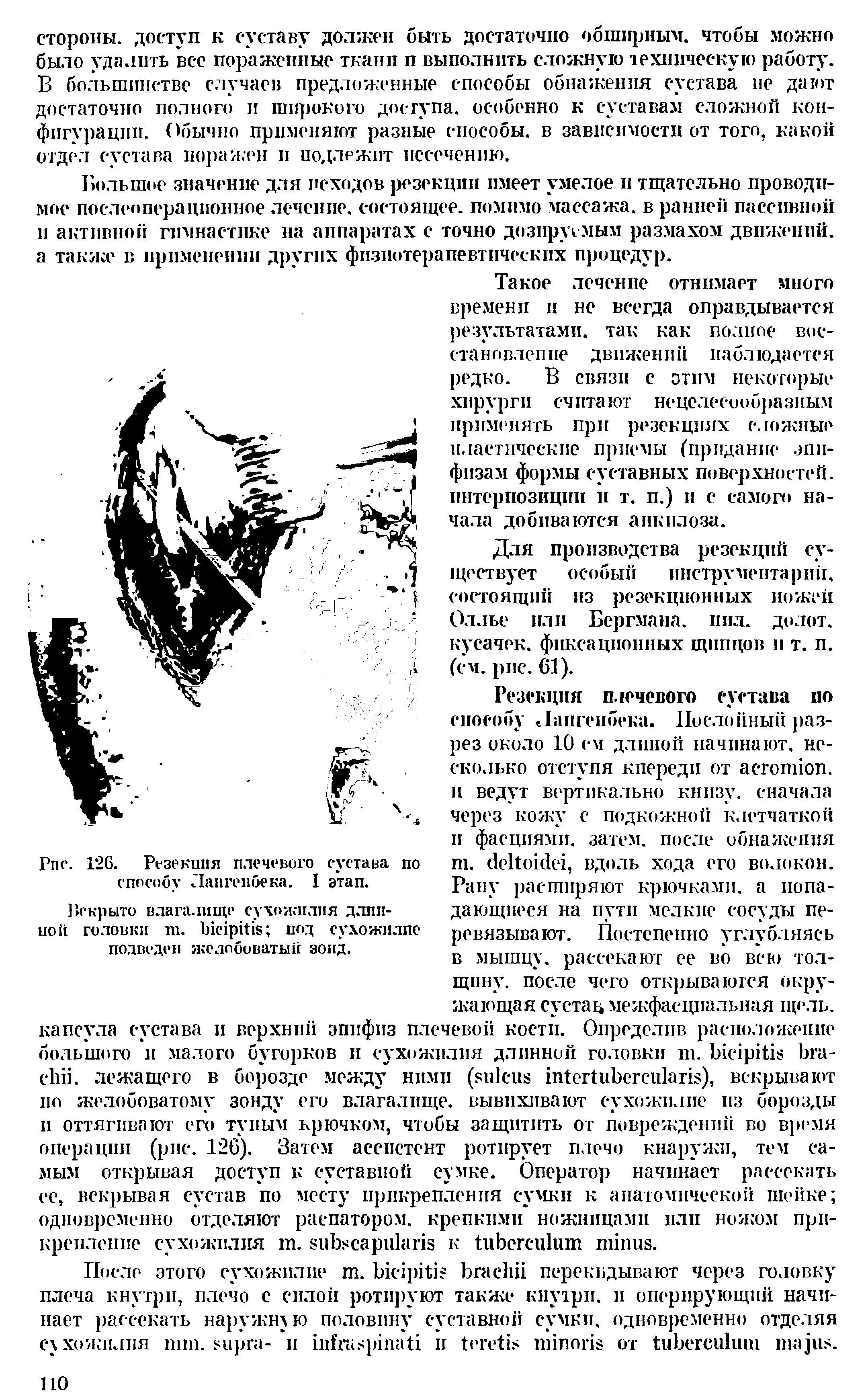 Рис. 126. Резекция плечевого сустава по способу Лаигенбека. I этап.