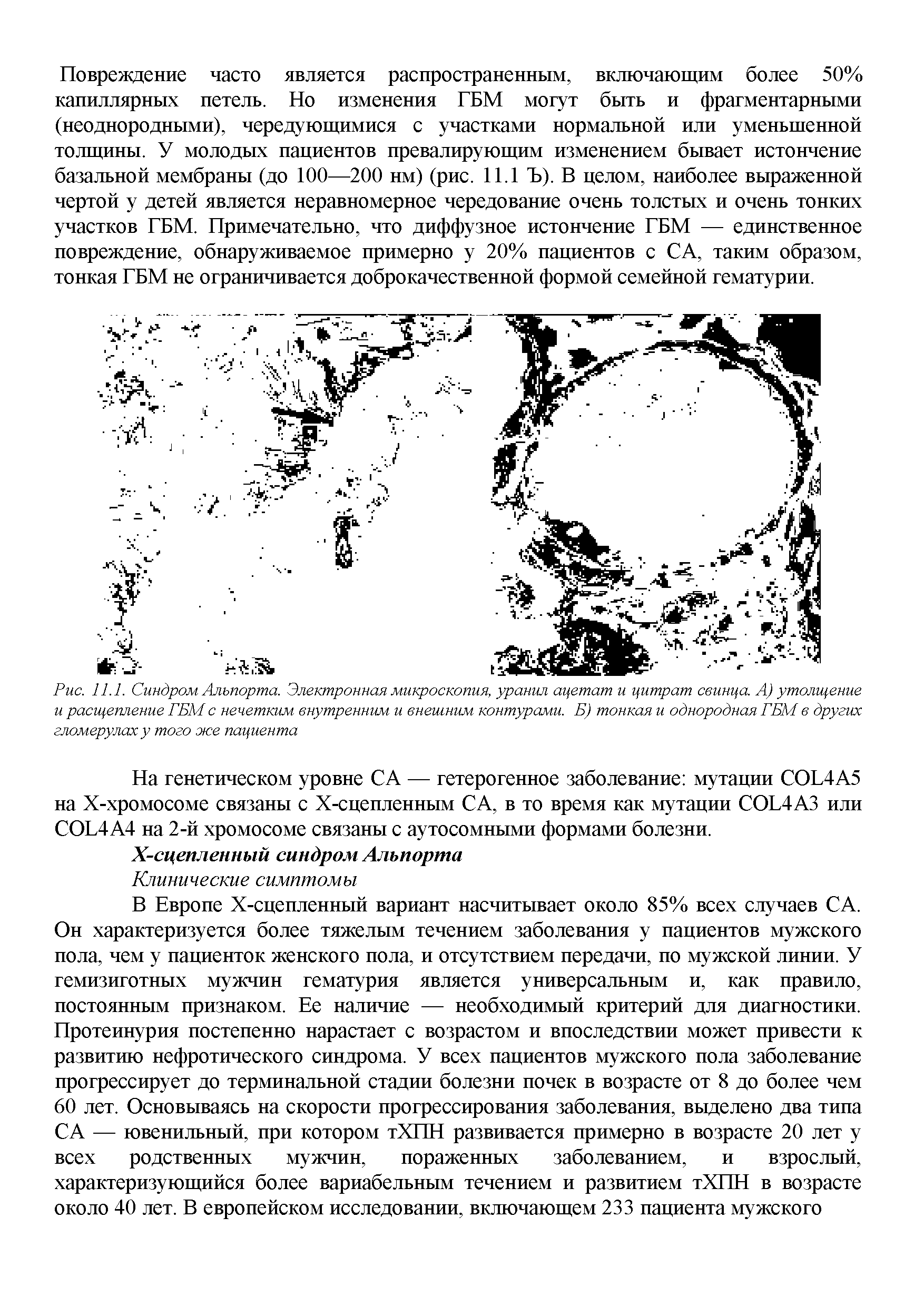 Рис. 11.1. Синдром Альпорта. Электронная микроскопия, уранил ацетат и цитрат свинца. А) утолщение и расщепление ГБМ с нечетким внутренним и внешним контурами. Б) тонкая и однородная ГБМ в других гломерулаху того же пациента...