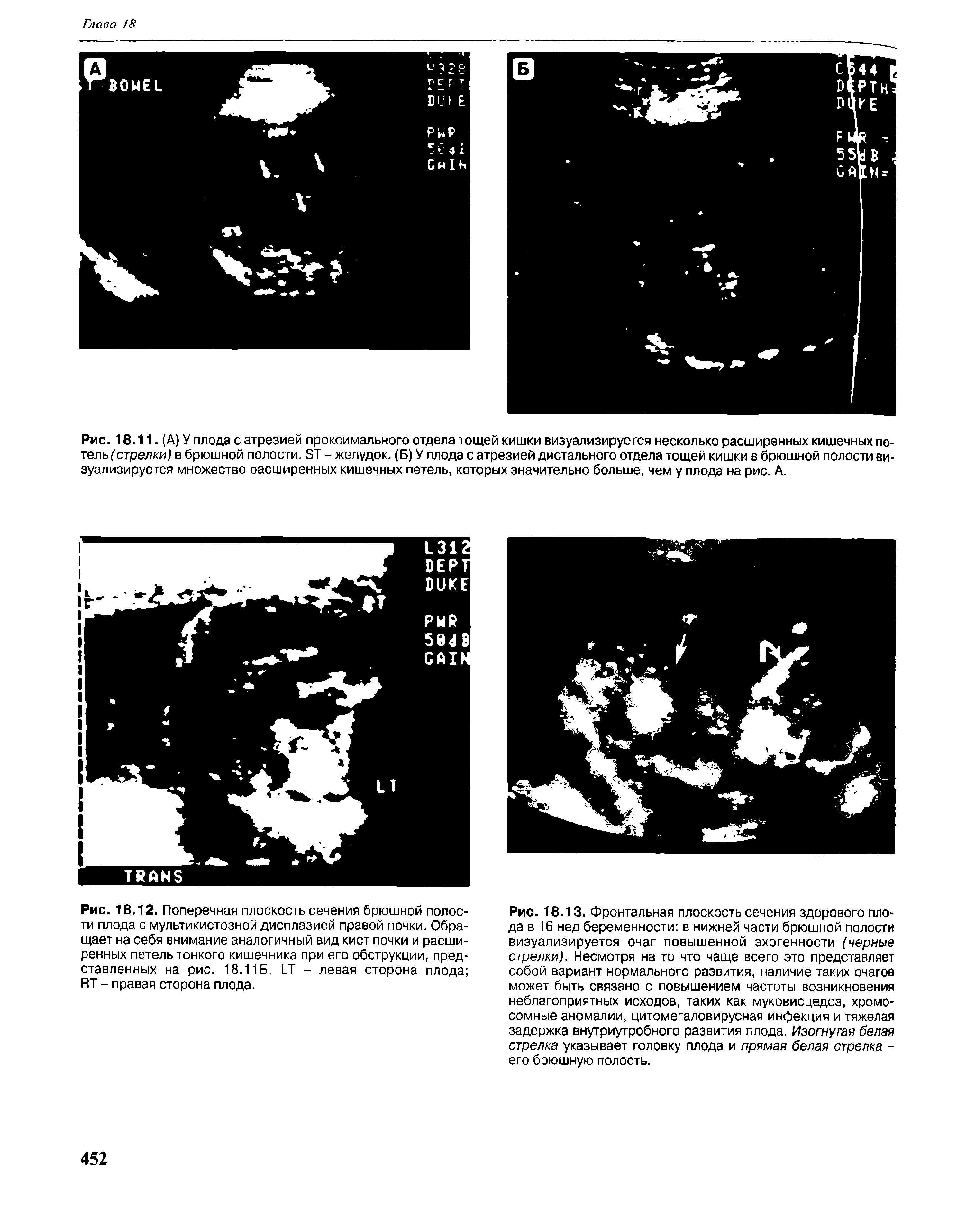 Рис. 18.11. (А) У плода с атрезией проксимального отдела тощей кишки визуализируется несколько расширенных кишечных петель (стрелки) в брюшной полости. БТ - желудок. (Б) У плода с атрезией дистального отдела тощей кишки в брюшной полости визуализируется множество расширенных кишечных петель, которых значительно больше, чем у плода на рис. А.