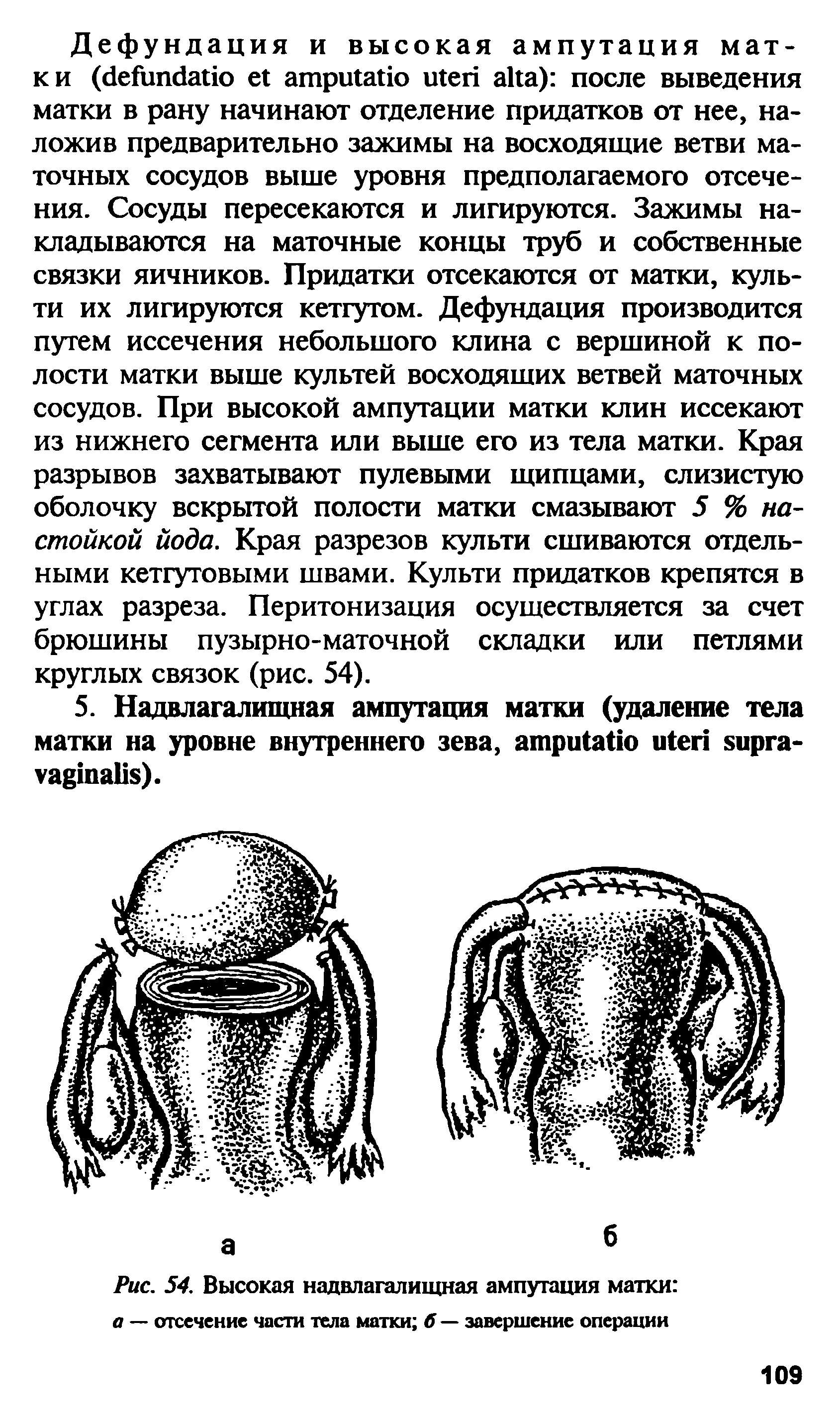 Рис. 54. Высокая надвлагалищная ампутация матки а — отсечение части тела матки б — завершение операции...