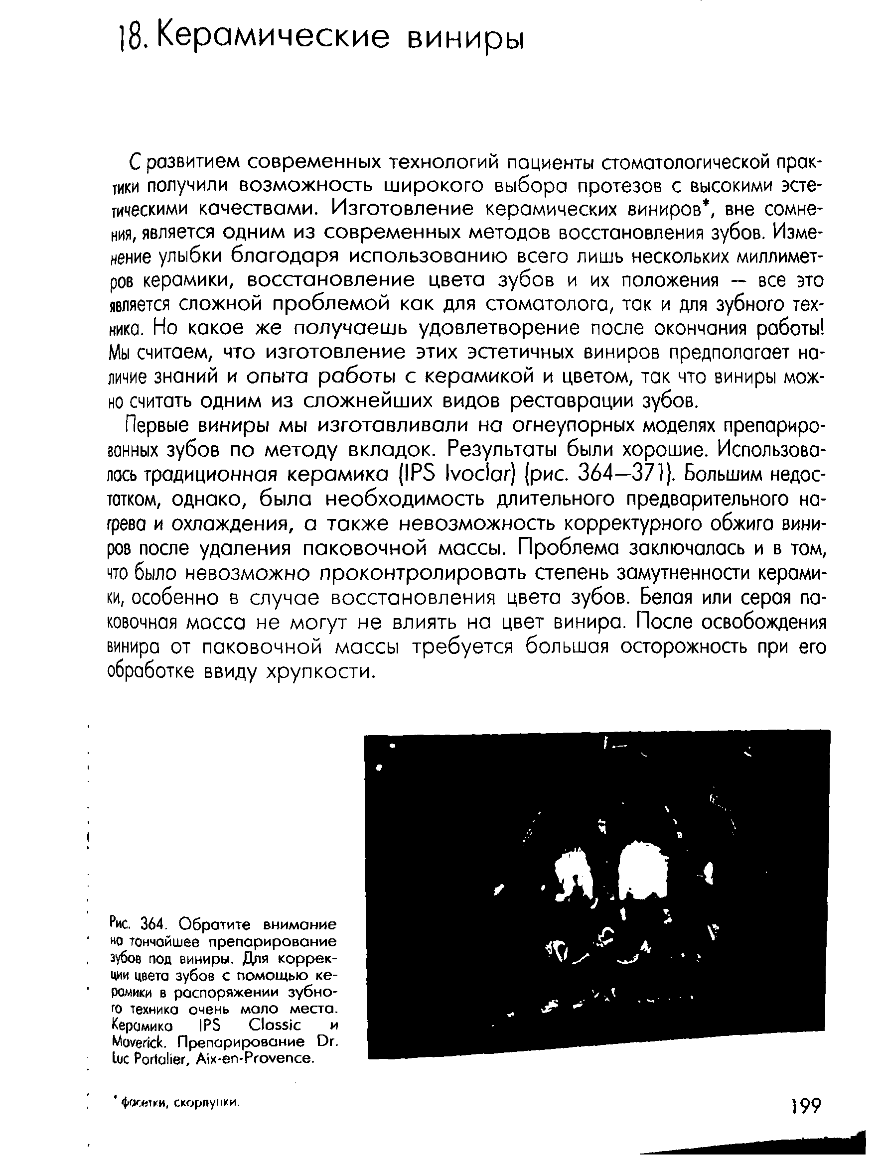 Рис. 364. Обратите внимание но тончайшее препарирование зубов под виниры. Для коррекции цвета зубов с помощью ке-ромики в распоряжении зубного техника очень мало места. Керамико IPS C и M . Препарирование D . L P , A - -P .