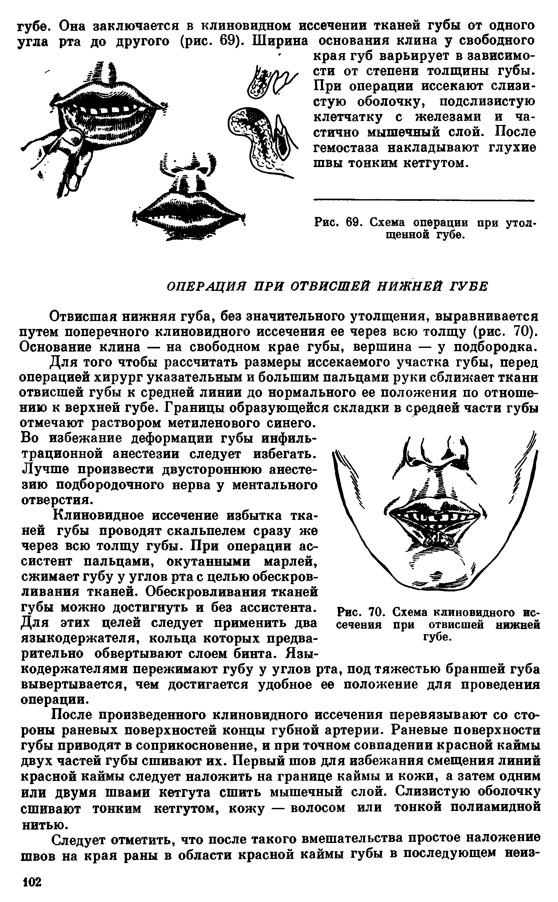 Рис. 70. Схема клиновидного иссечения при отвисшей нижней губе.