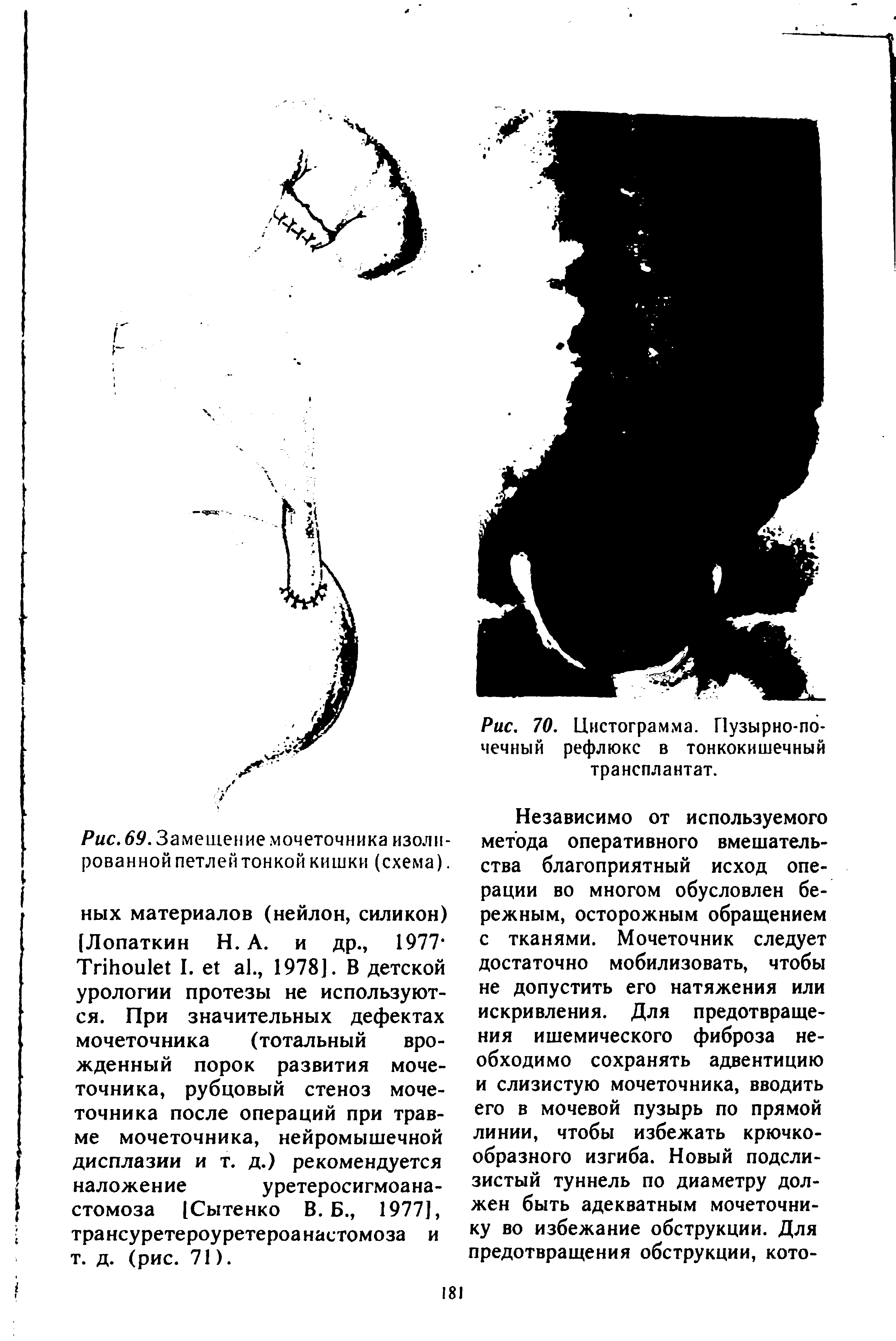 Рис. 69. Замещение мочеточника изолированной петлей тонкой кишки (схема).