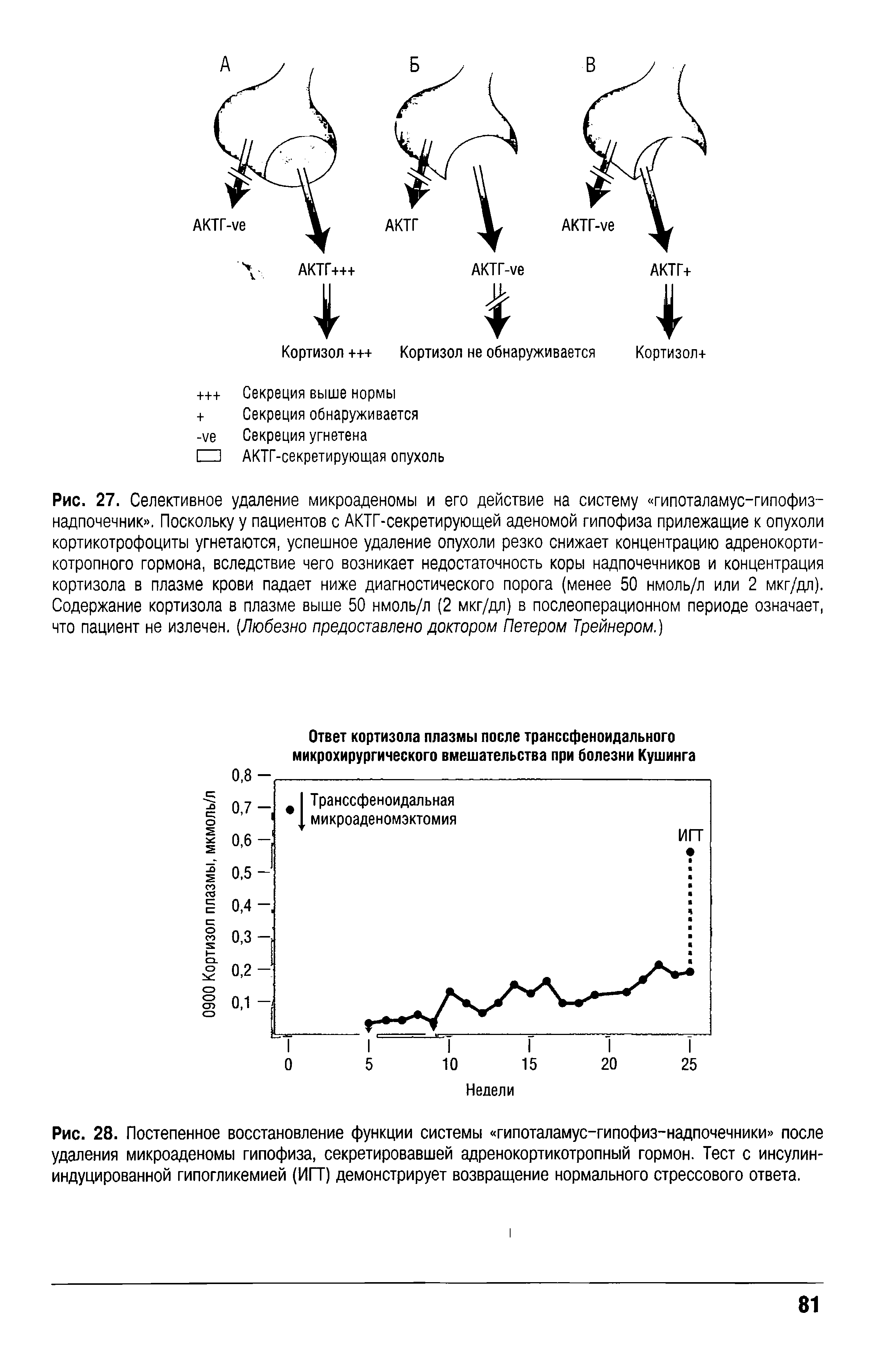 Рис. 28. Постепенное восстановление функции системы гипоталамус-гипофиз-надпочечники после удаления микроаденомы гипофиза, секретировавшей адренокортикотропный гормон. Тест с инсулин-индуцированной гипогликемией (ИГТ) демонстрирует возвращение нормального стрессового ответа.