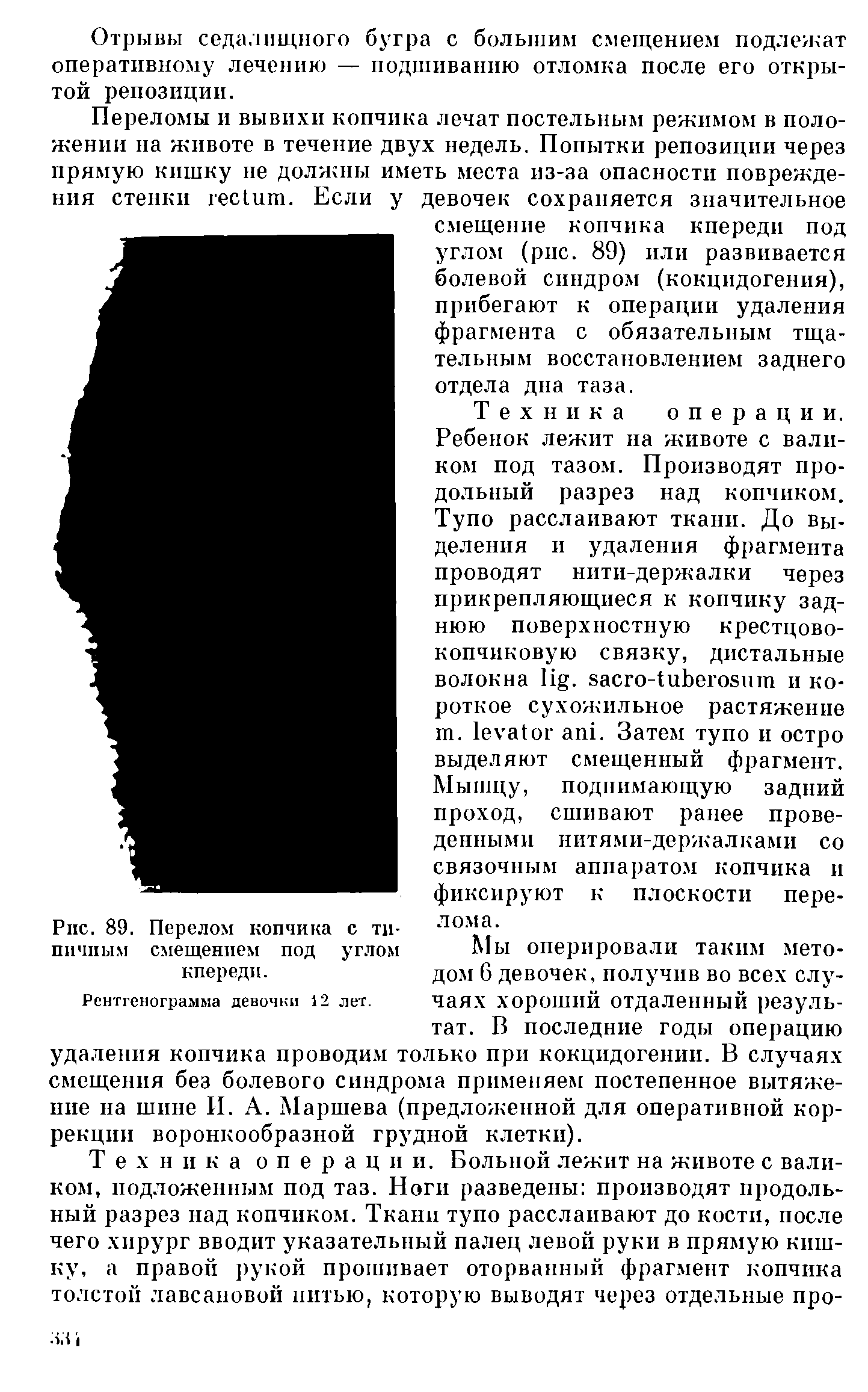 Рис. 89. Перелом копчика с типичным смещением под углом кпереди.