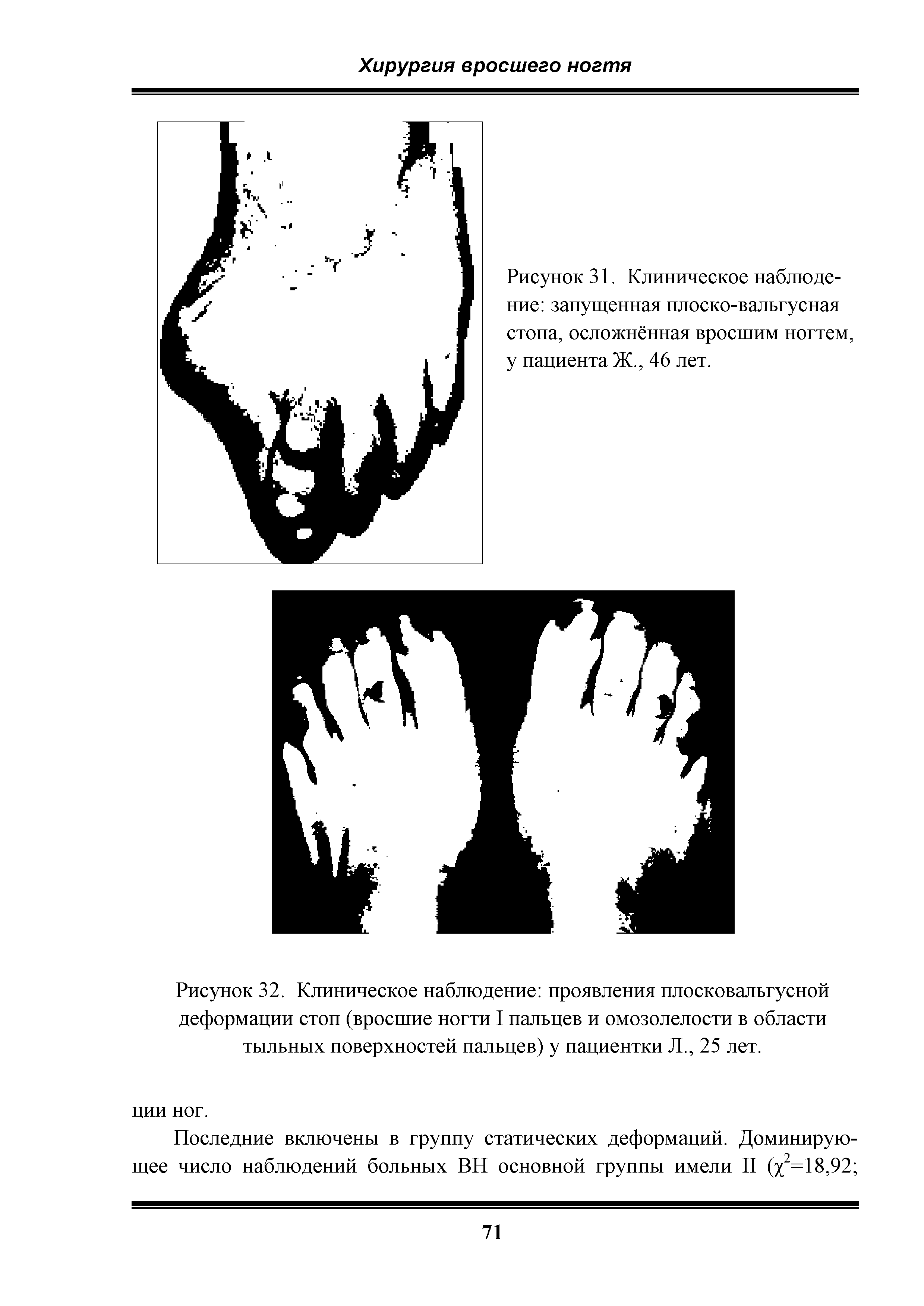 Рисунок 32. Клиническое наблюдение проявления плосковальгусной деформации стоп (вросшие ногти I пальцев и омозолелости в области тыльных поверхностей пальцев) у пациентки Л., 25 лет.