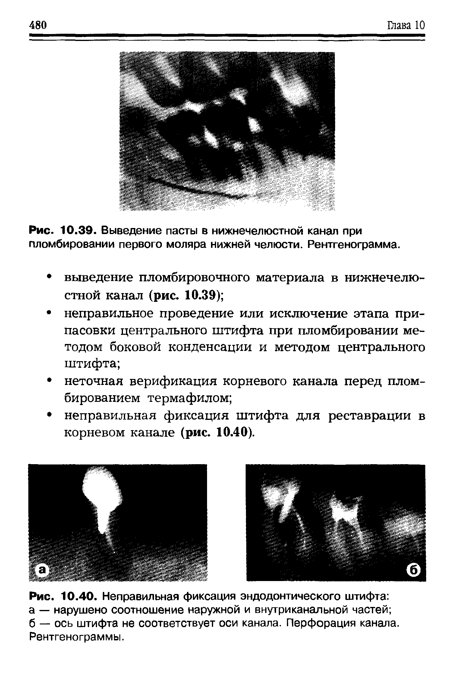 Рис. 10.40. Неправильная фиксация эндодонтического штифта а — нарушено соотношение наружной и внутриканальной частей б — ось штифта не соответствует оси канала. Перфорация канала. Рентгенограммы.