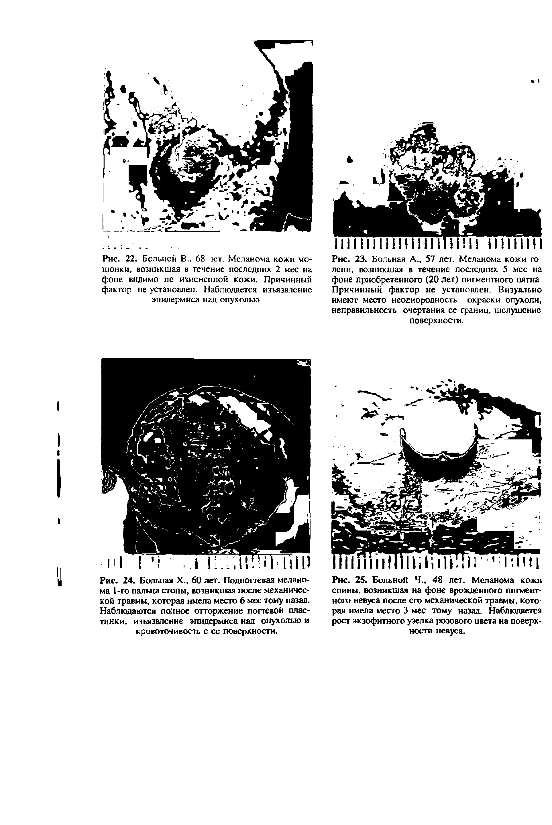 Рис. 24. Больная X., 60 лет. Подногтевая меланома 1-го пальца стопы, возникшая после механической травмы, которая имела место 6 мес тому назад. Наблюдаются полное отторжение ногтевой пластинки. изъязвление эпидермиса над опухолью и кровоточивость с ее поверхности.