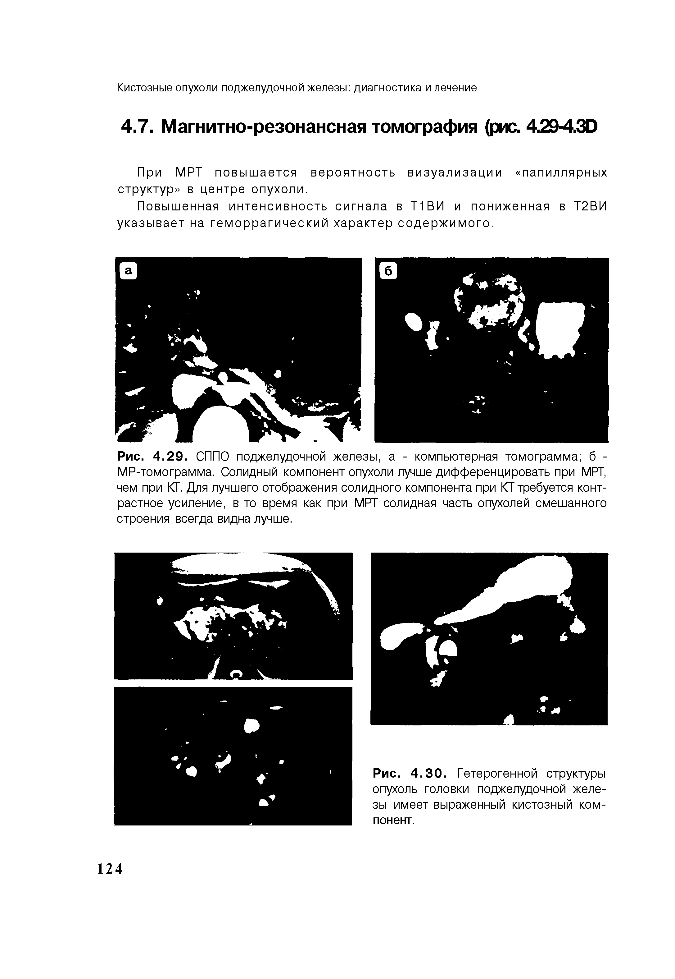 Рис. 4.29. СППО поджелудочной железы, а - компьютерная томограмма б -MP-томограмма. Солидный компонент опухоли лучше дифференцировать при МРТ, чем при КТ. Для лучшего отображения солидного компонента при КТ требуется контрастное усиление, в то время как при МРТ солидная часть опухолей смешанного строения всегда видна лучше.