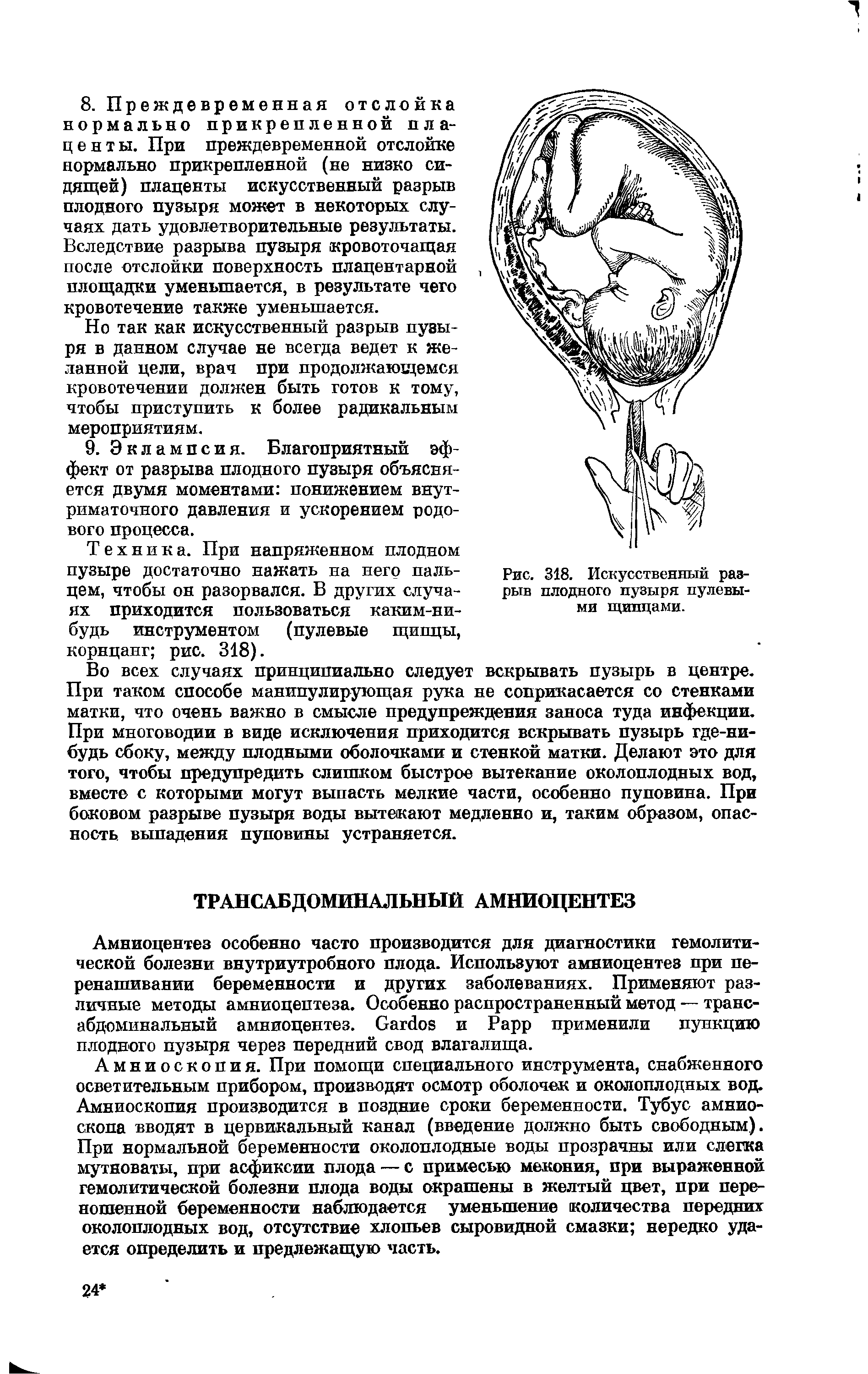 Рис. 318. Искусственный разрыв плодного пузыря пулевыми щипцами.