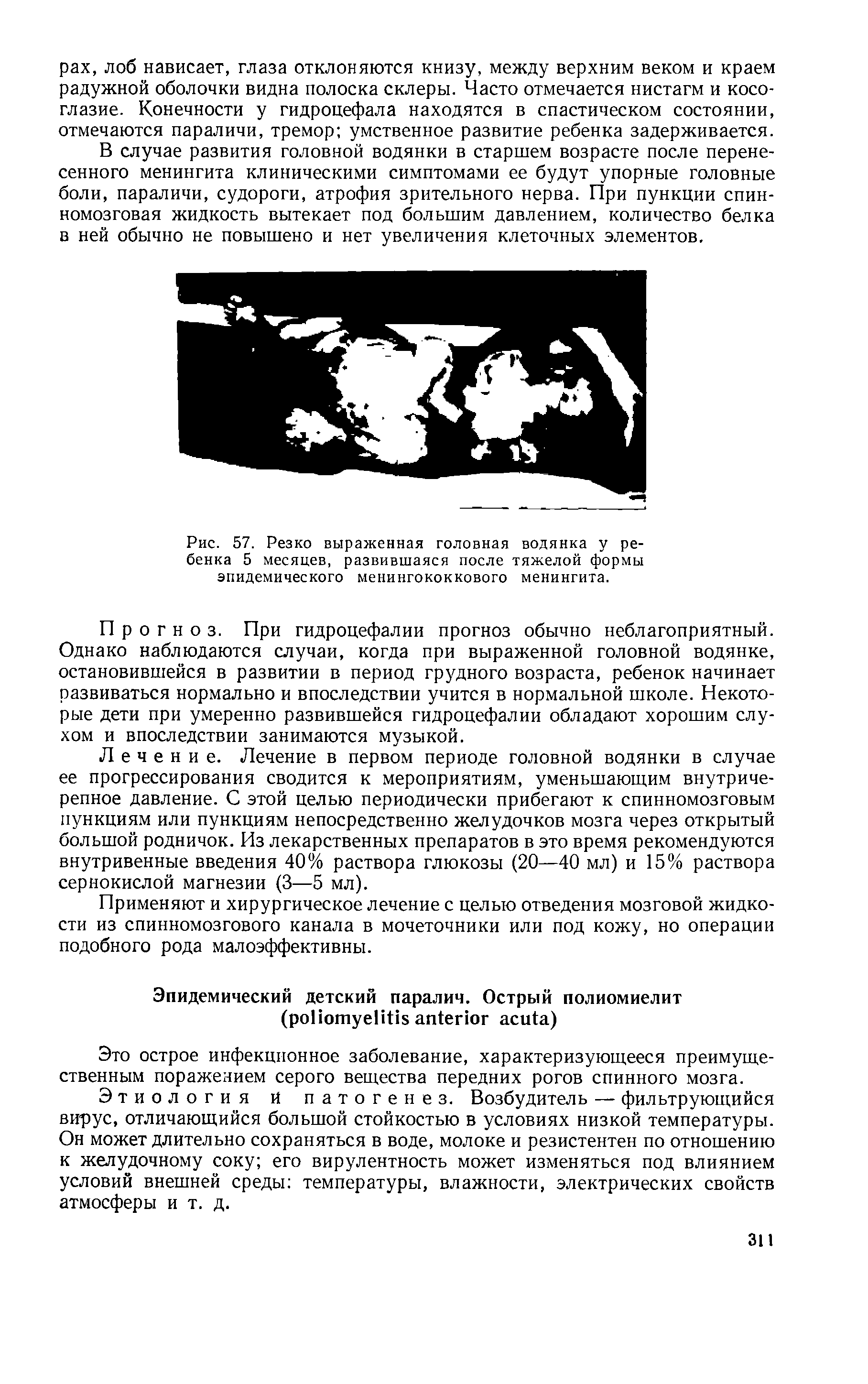 Рис. 57. Резко выраженная головная водянка у ребенка 5 месяцев, развившаяся после тяжелой формы эпидемического менингококкового менингита.