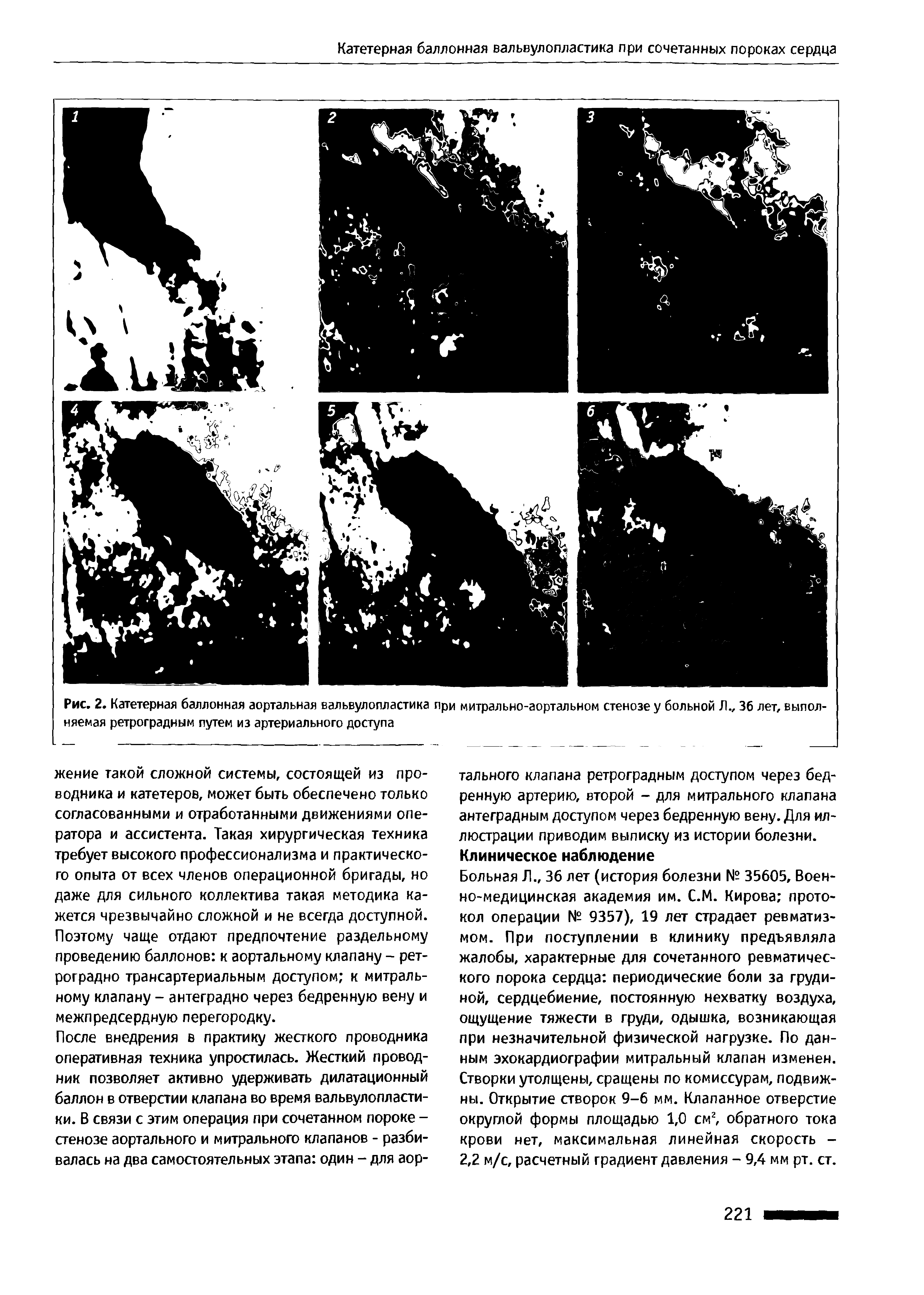 Рис. 2. Катетерная баллонная аортальная вальвулопластика при митрально-аортальном стенозе у больной Л., 36 лет, выполняемая ретроградным путем из артериального доступа...