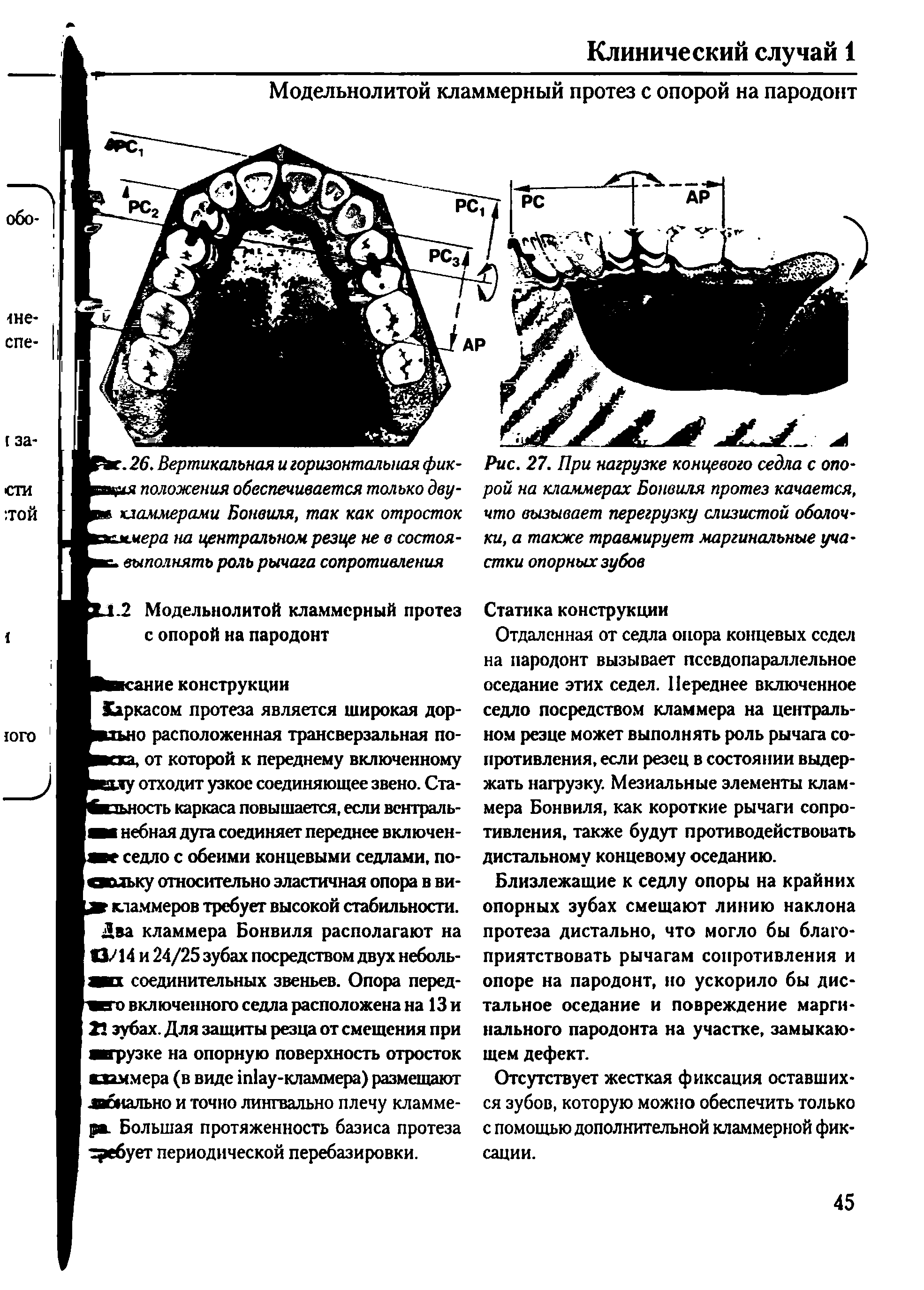Рис. 27. При нагрузке концевого седла с опорой на кламмерах Бонвиля протез качается, что вызывает перегрузку слизистой оболочки, а также травмирует маргинальные участки опорных зубов...