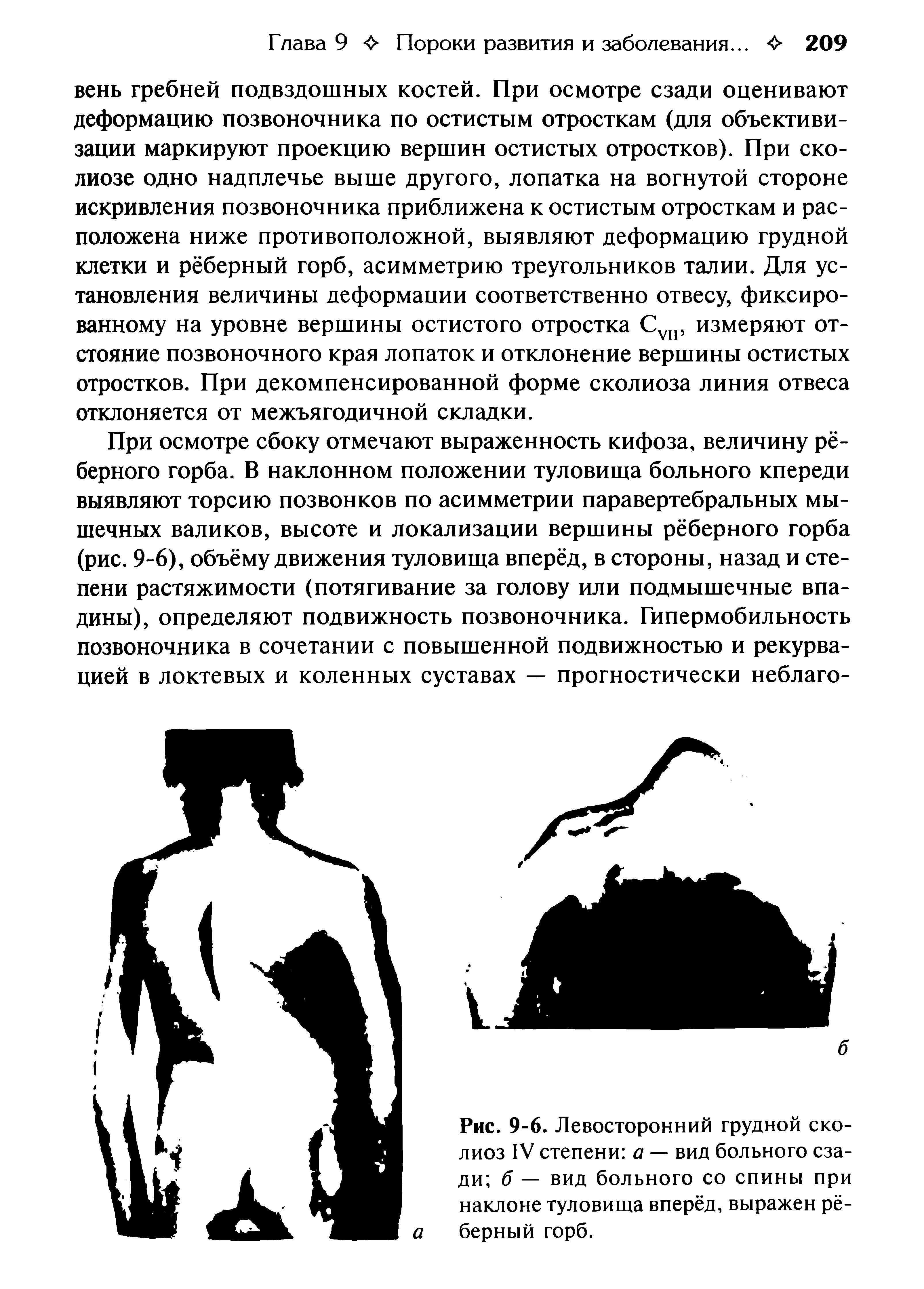 Рис. 9-6. Левосторонний грудной сколиоз IV степени а — вид больного сзади б — вид больного со спины при наклоне туловища вперёд, выражен рёберный горб.