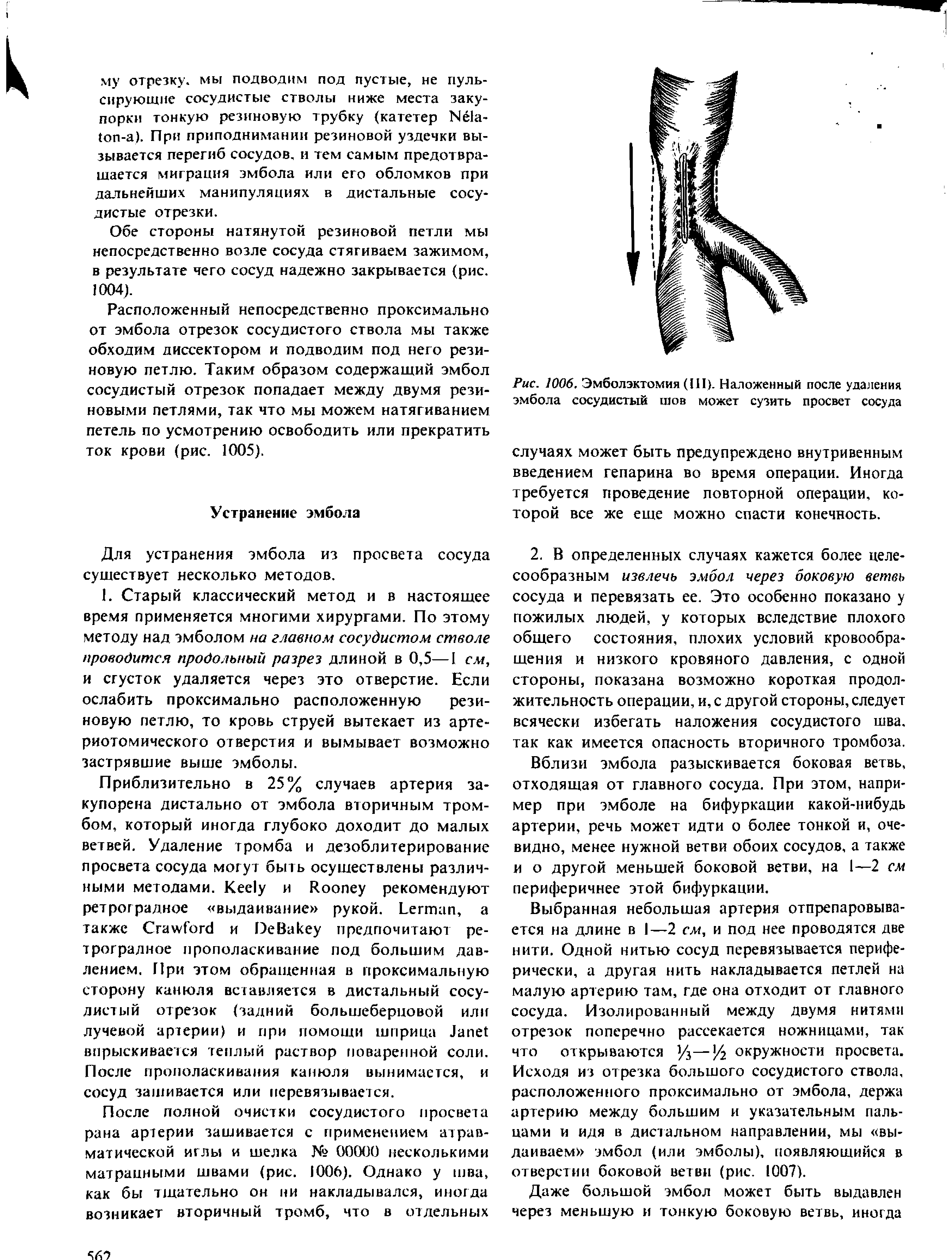 Рис. 1006, Эмболэктомия (III). Наложенный после удаления эмбола сосудистый шов может сузить просвет сосуда случаях может быть предупреждено внутривенным введением гепарина во время операции. Иногда требуется проведение повторной операции, которой все же еще можно спасти конечность.