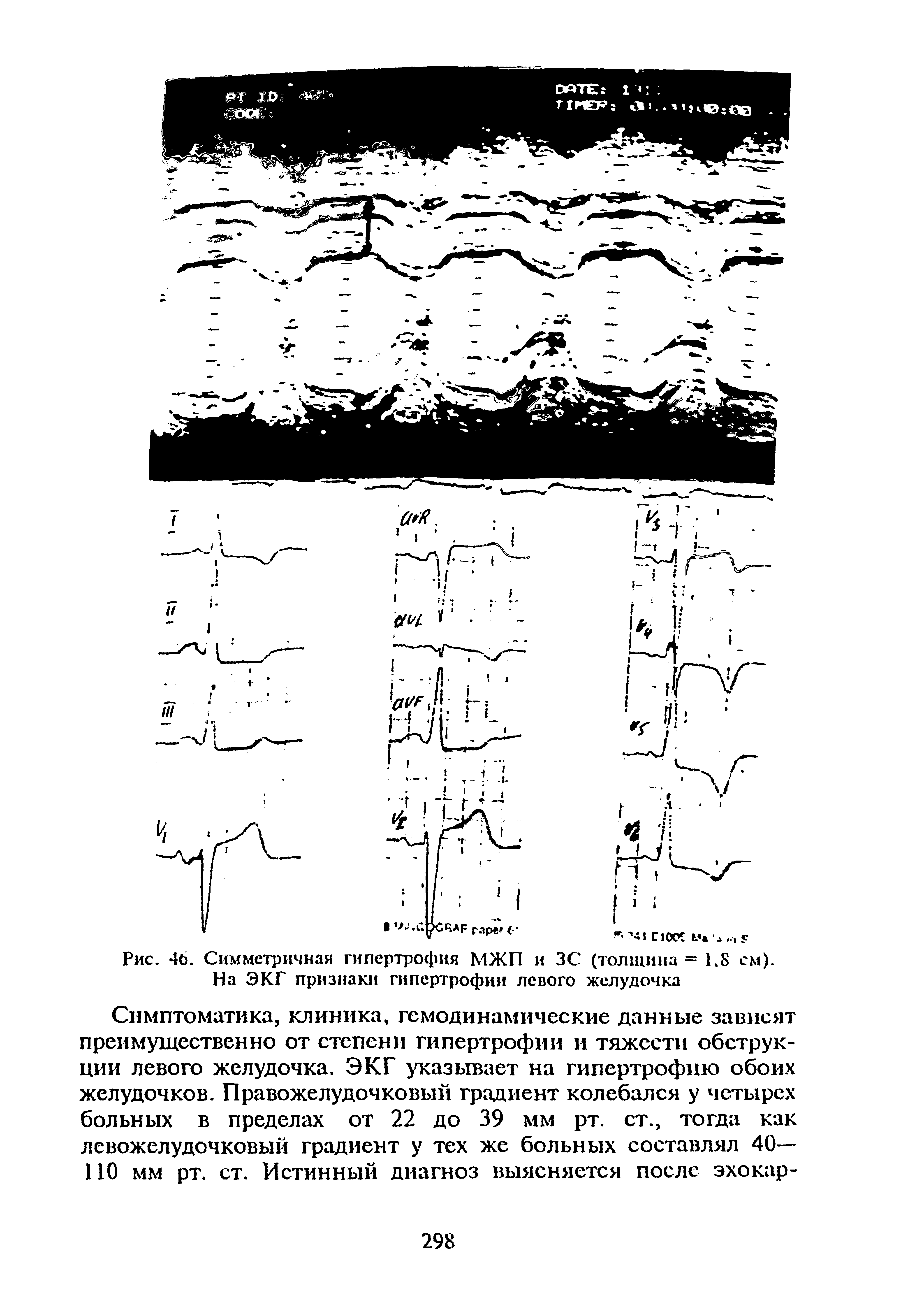 Рис. 46. Симметричная гипертрофия МЖП и ЗС (толщина = 1.8 см). На ЭКГ признаки гипертрофии левого желудочка...