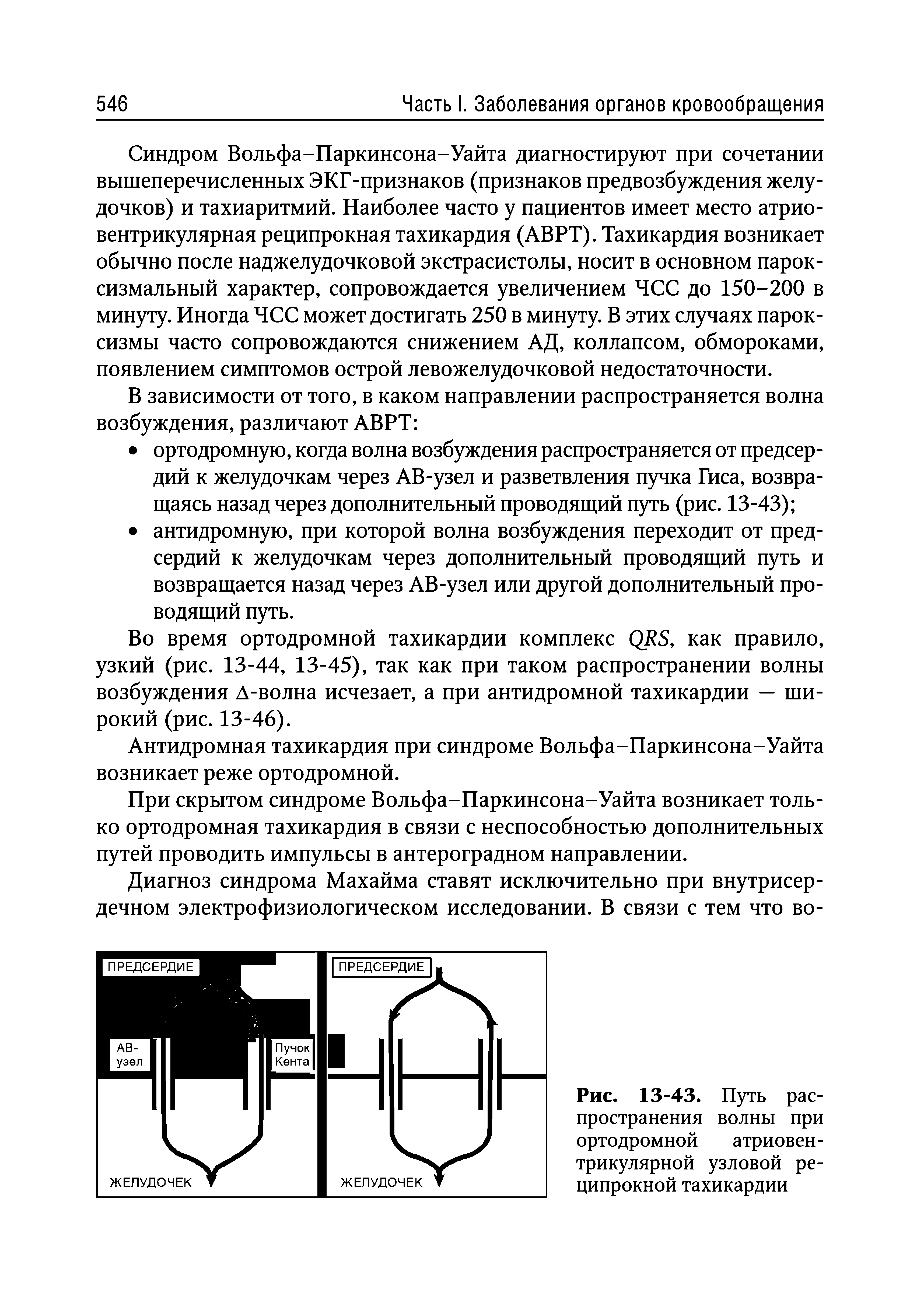 Рис. 13-43. Путь распространения волны при ортодромной атриовентрикулярной узловой реципрокной тахикардии...