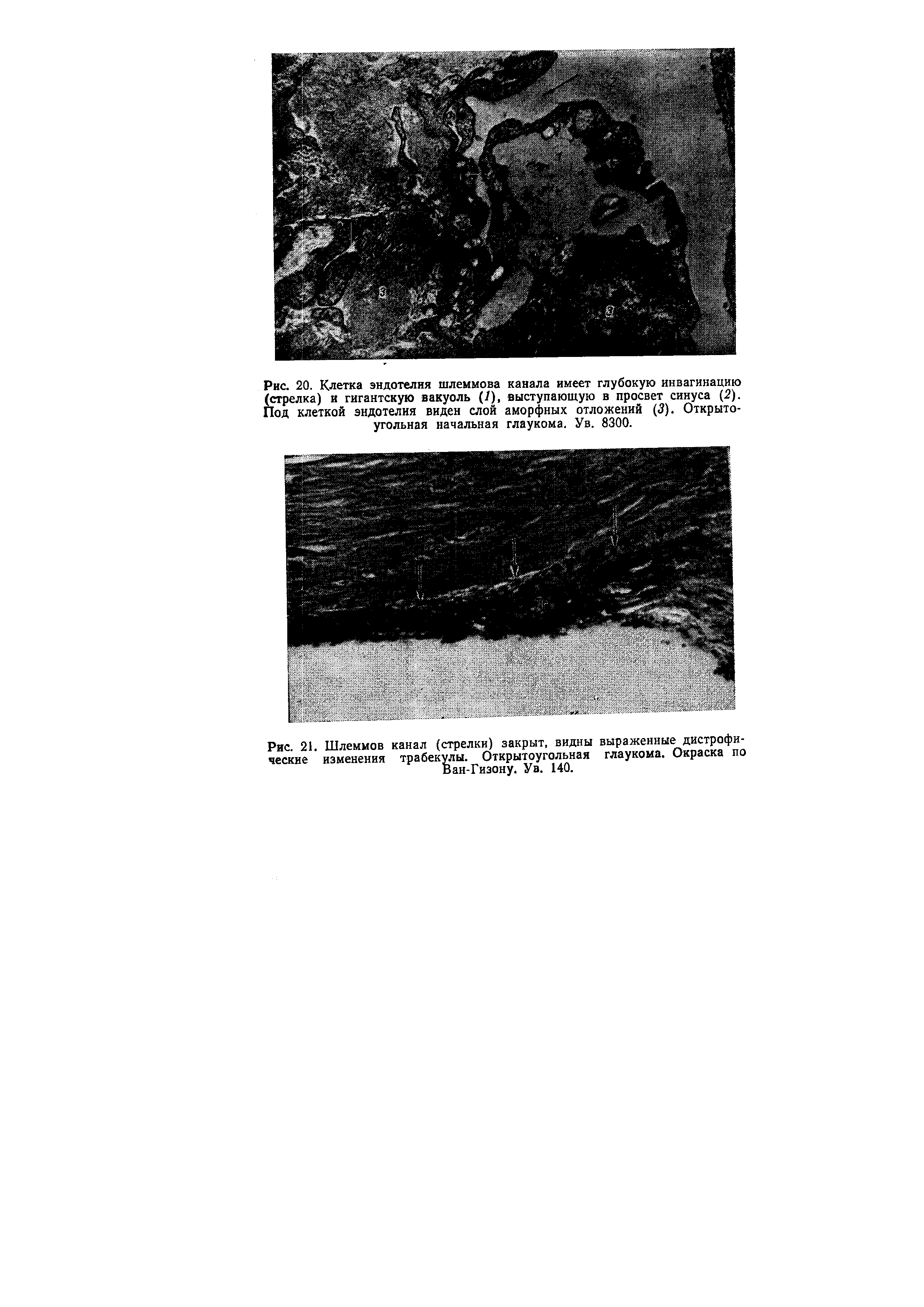 Рис. 21. Шлеммов канал (стрелки) закрыт, видны выраженные дистрофические изменения трабекулы. Открытоугольная глаукома. Окраска по Ван-Гизону. Ув. 140.