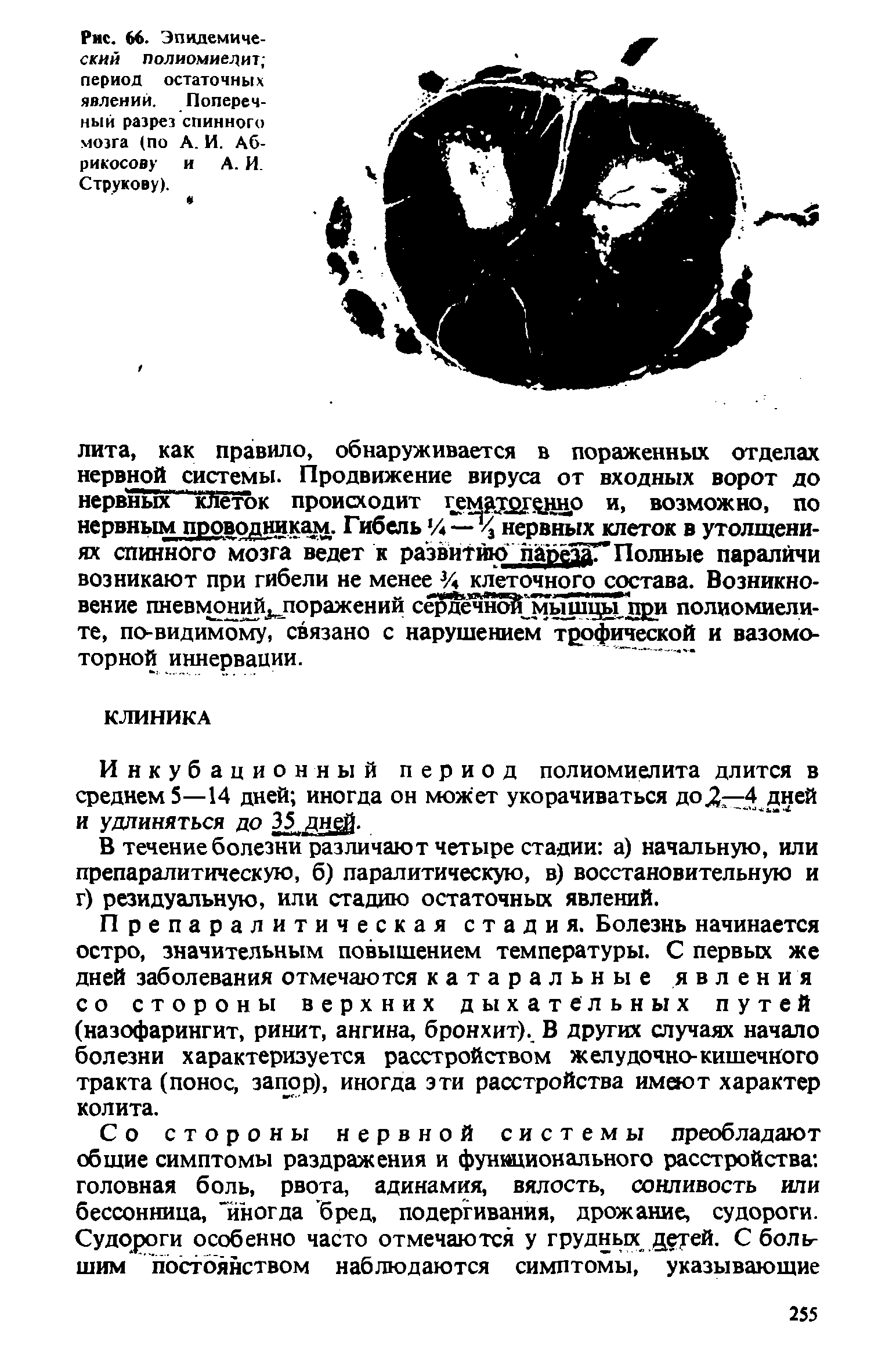 Рис. 66. Эпидемический полиомиелит период остаточных явлений. Поперечный разрез спинного мозга (по А. И. Абрикосову и А. И. Струкову).