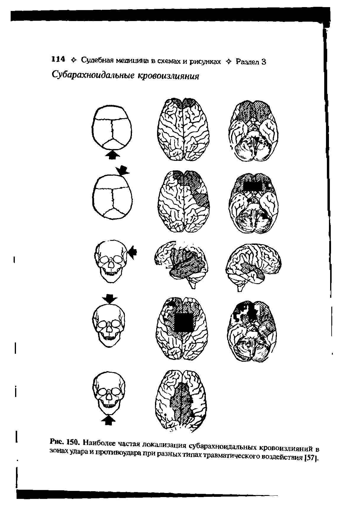 Рис. 150. Наиболее частая локализация субарахноидальных кровоизлияний в зонах удара и вротивоудара при разных типах травматического воздействия 157].
