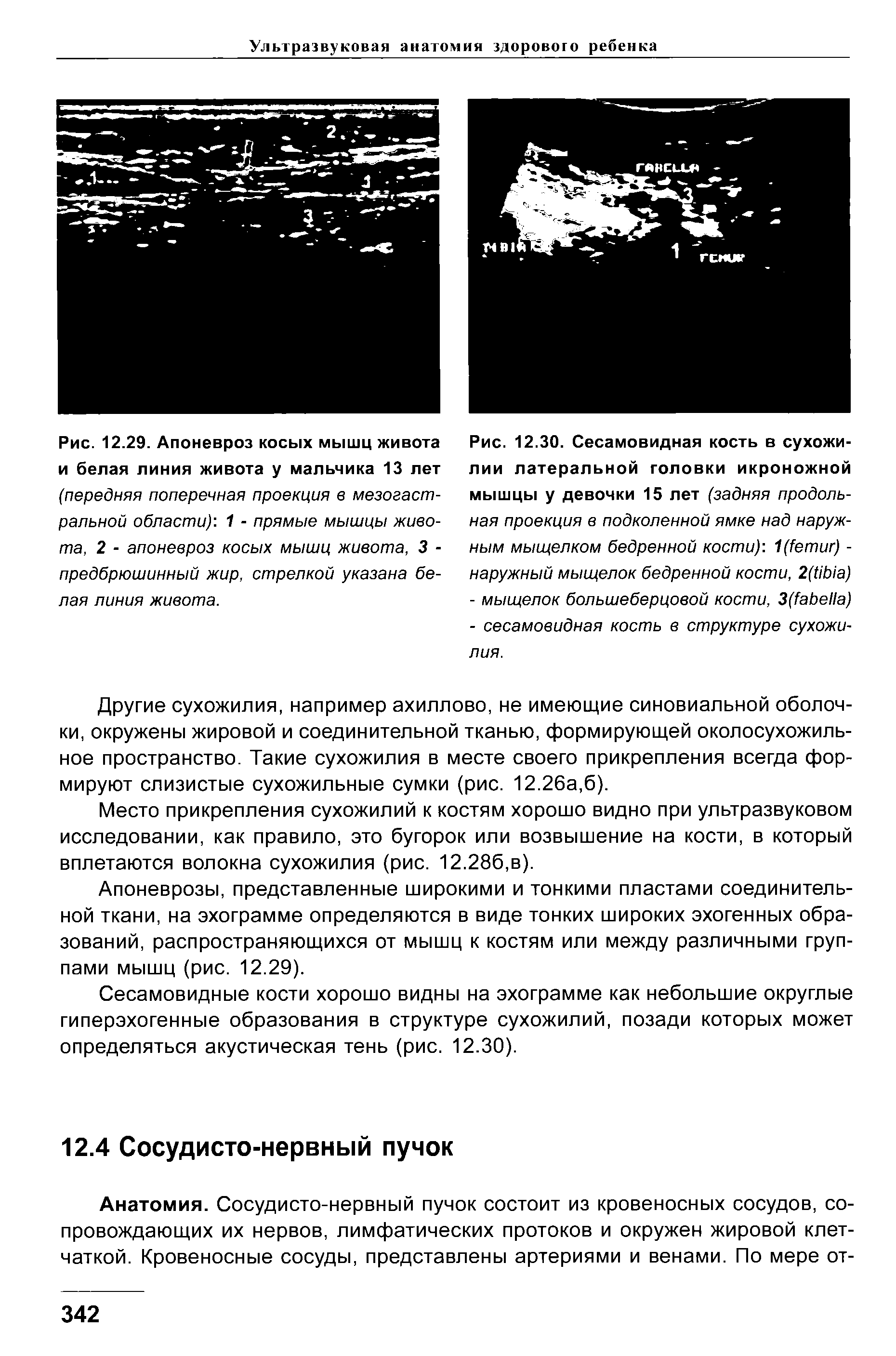 Рис. 12.29. Апоневроз косых мышц живота и белая линия живота у мальчика 13 лет (передняя поперечная проекция в мезогаст-ральной области) 1 - прямые мышцы живота, 2 - апоневроз косых мышц живота, 3 -предбрюшинный жир, стрелкой указана белая линия живота.