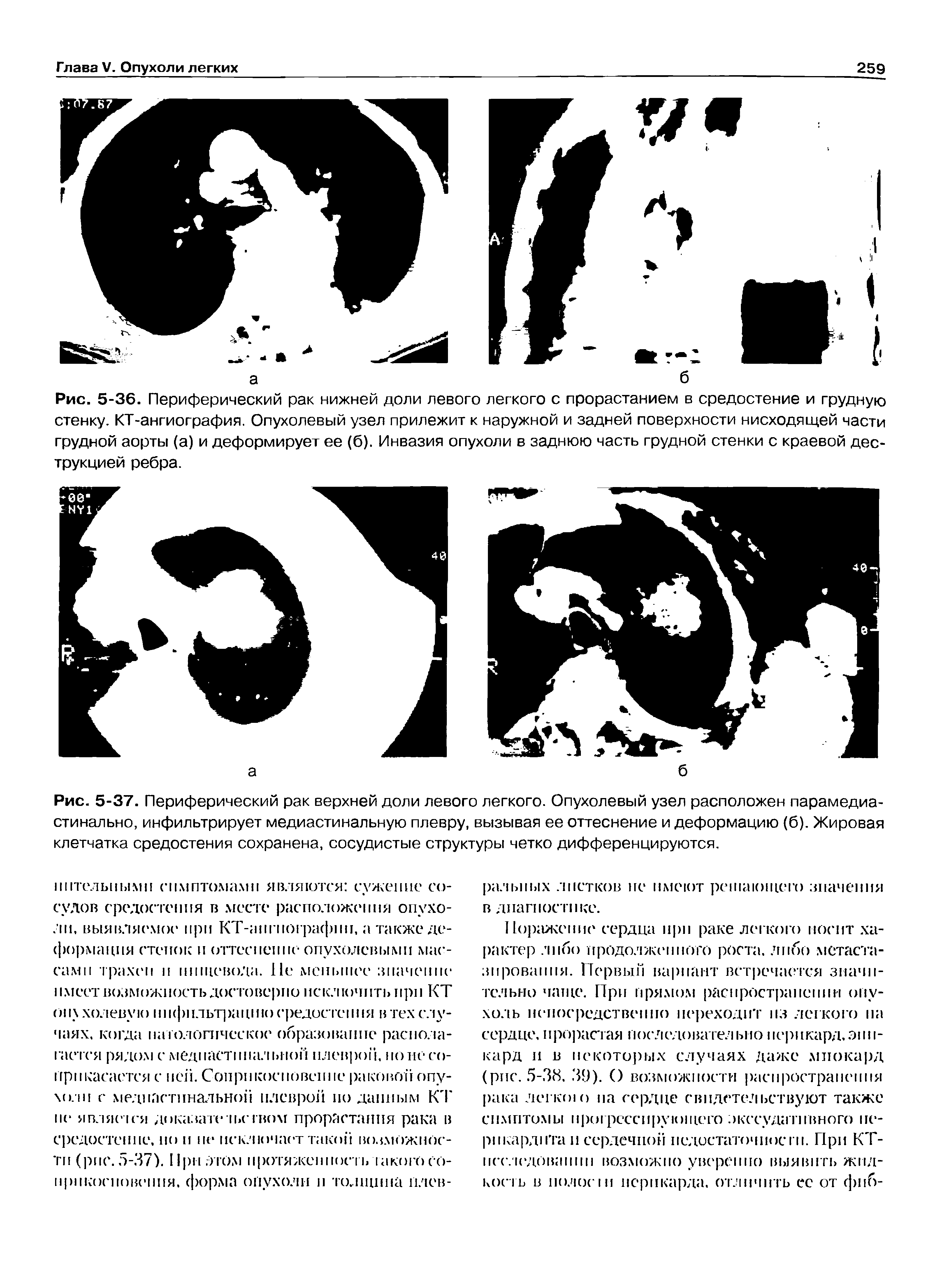 Рис. 5-37. Периферический рак верхней доли левого легкого. Опухолевый узел расположен парамедиа-стинально, инфильтрирует медиастинальную плевру, вызывая ее оттеснение и деформацию (б). Жировая клетчатка средостения сохранена, сосудистые структуры четко дифференцируются.