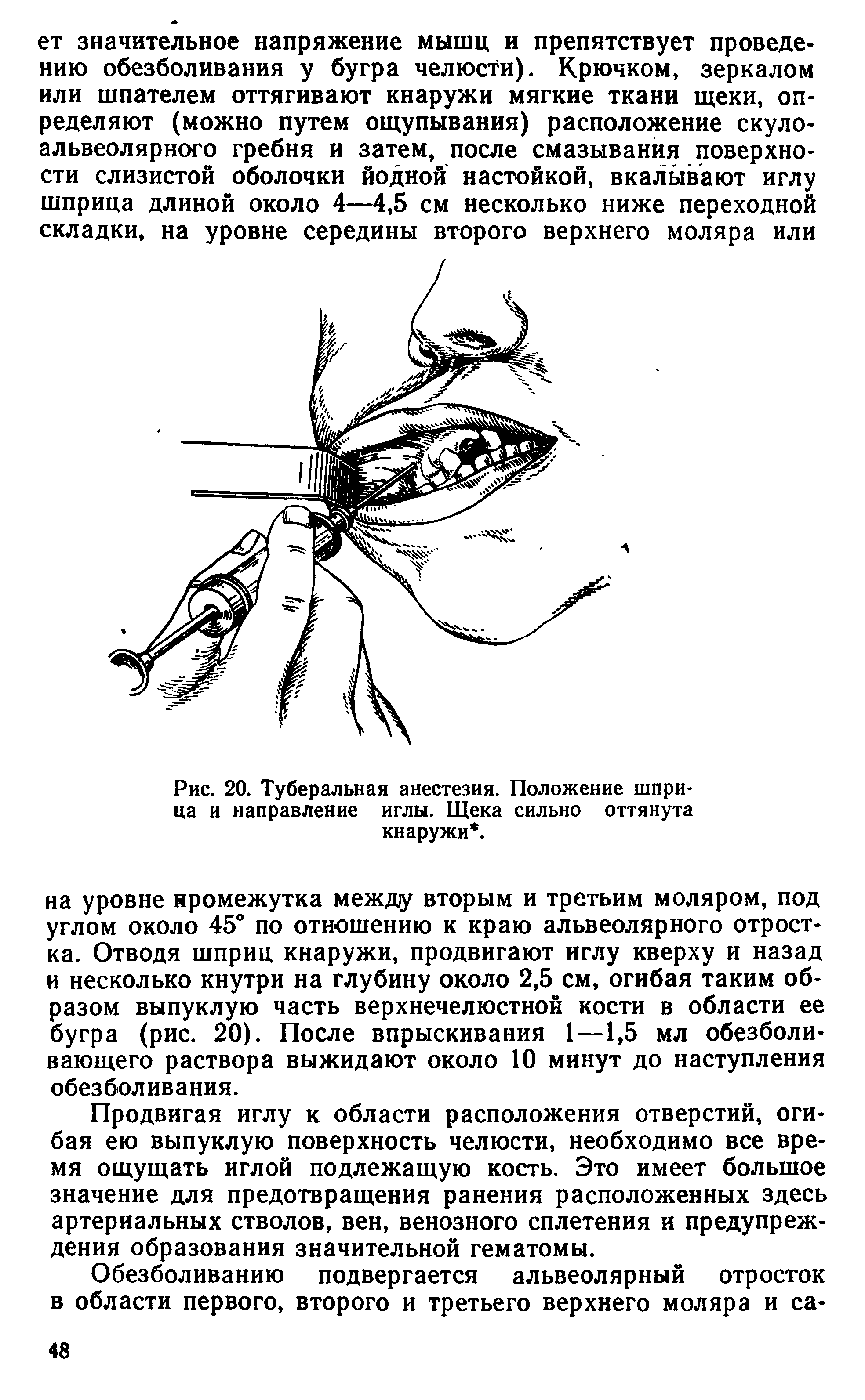 Рис. 20. Туберальная анестезия. Положение шприца и направление иглы. Щека сильно оттянута кнаружи. ...