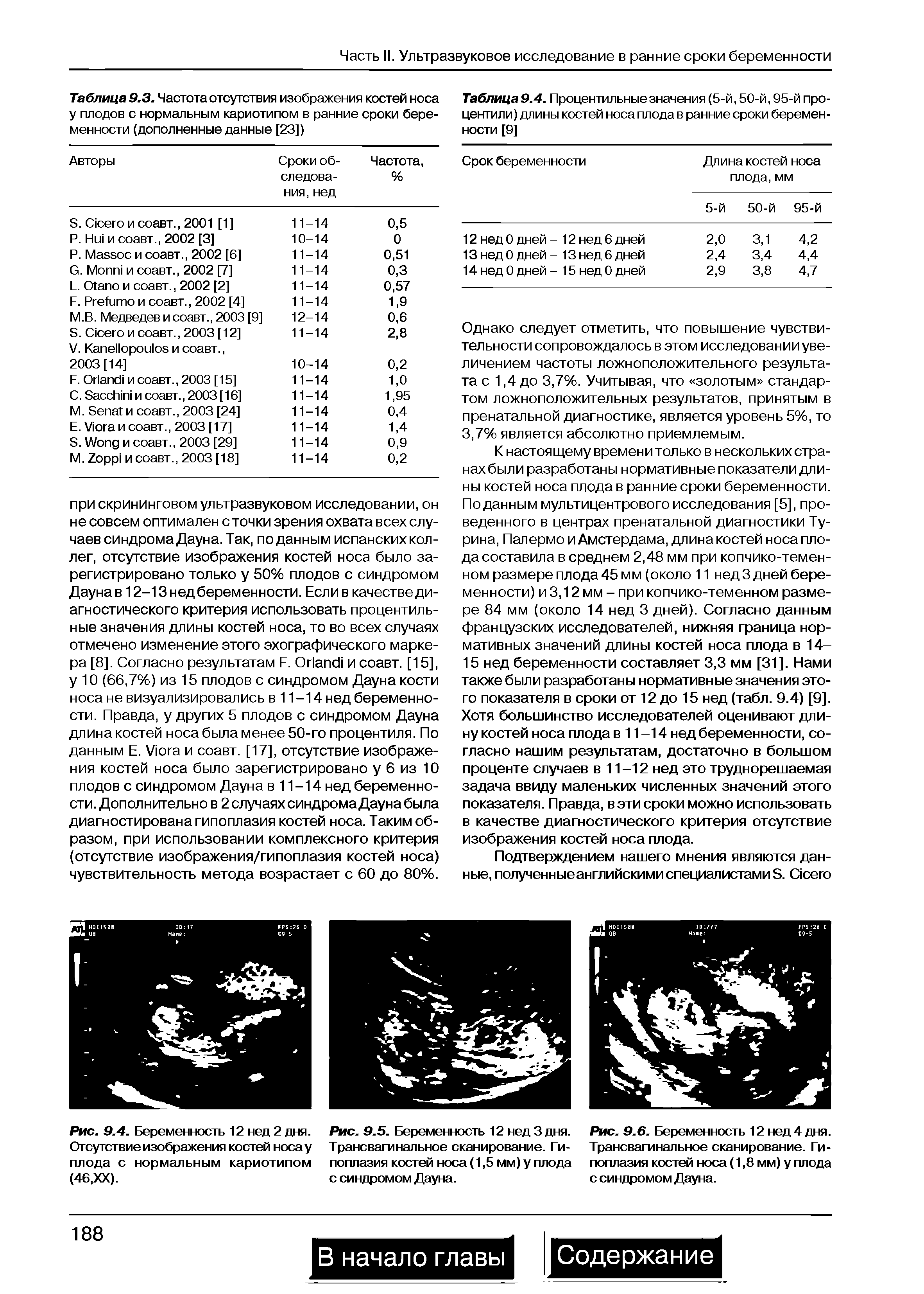 Рис. 9.5. Беременность 12 нед 3 дня. Трансвагинальное сканирование. Гипоплазия костей носа (1,5 мм) у плода с синдромом Дауна.