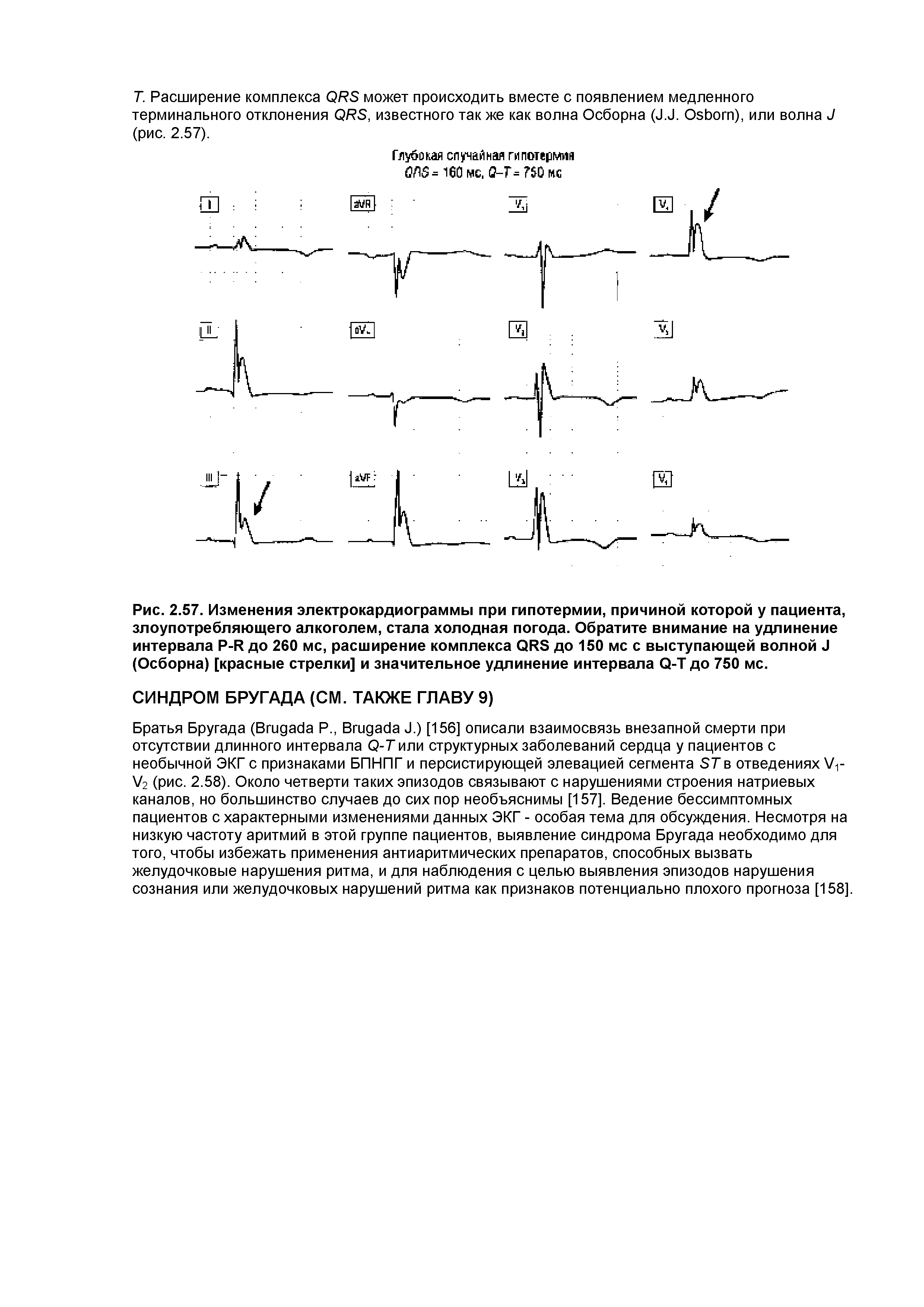 Рис. 2.57. Изменения электрокардиограммы при гипотермии, причиной которой у пациента, злоупотребляющего алкоголем, стала холодная погода. Обратите внимание на удлинение интервала P-R до 260 мс, расширение комплекса QRS до 150 мс с выступающей волной J (Осборна) [красные стрелки] и значительное удлинение интервала Q-Т до 750 мс.