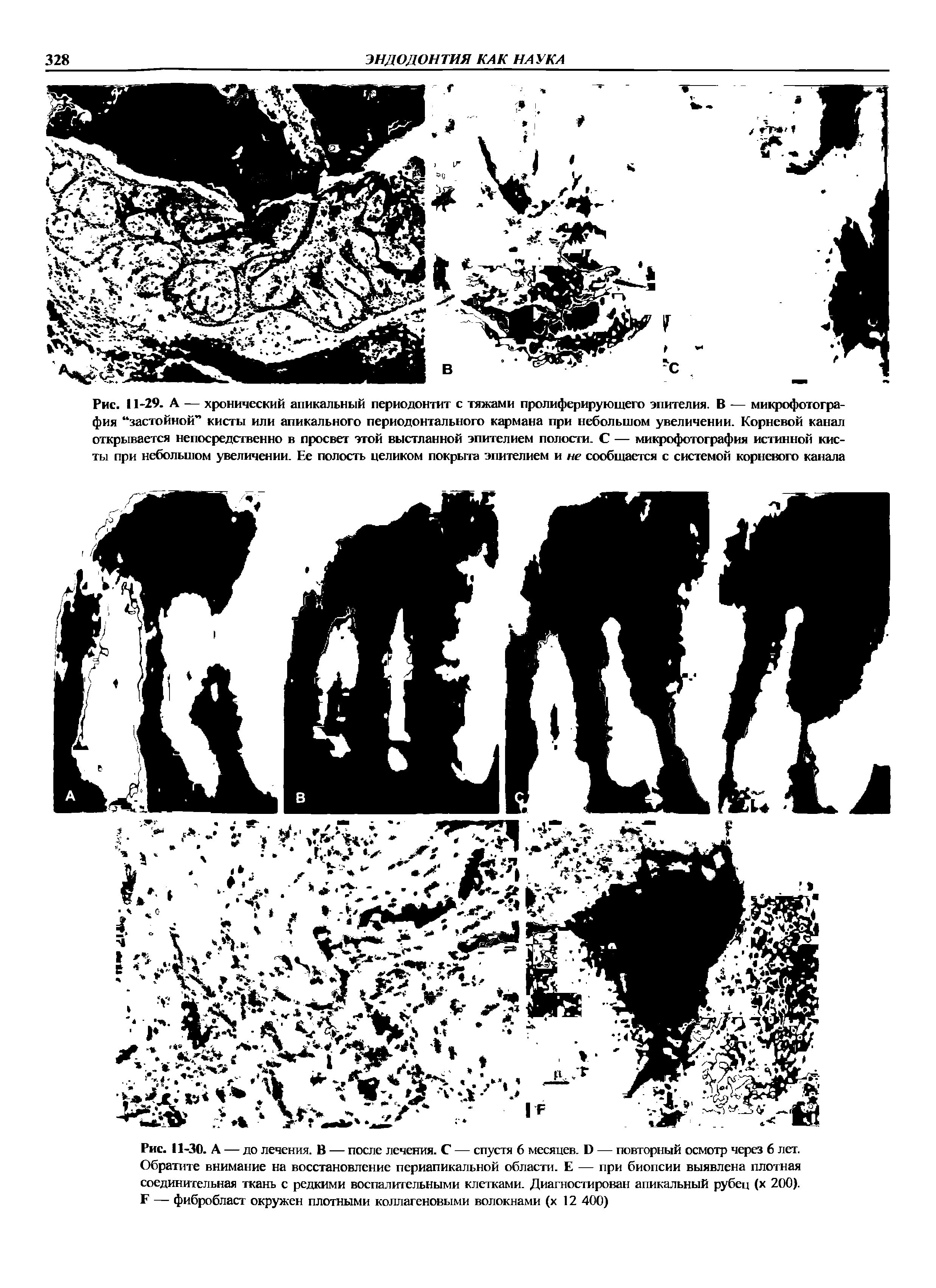 Рис. 11-30. А — до лечения. В — после лечения. С — спустя 6 месяцев. В — повторный осмотр через 6 лет. Обратите внимание на восстановление периапикальной области. Е — при биопсии выявлена плотная соединительная ткань с редкими воспалительными клетками. Диагностирован апикальный рубец (х 200). Г — фибробласт окружен плотными коллагеновыми волокнами (х 12 400)...