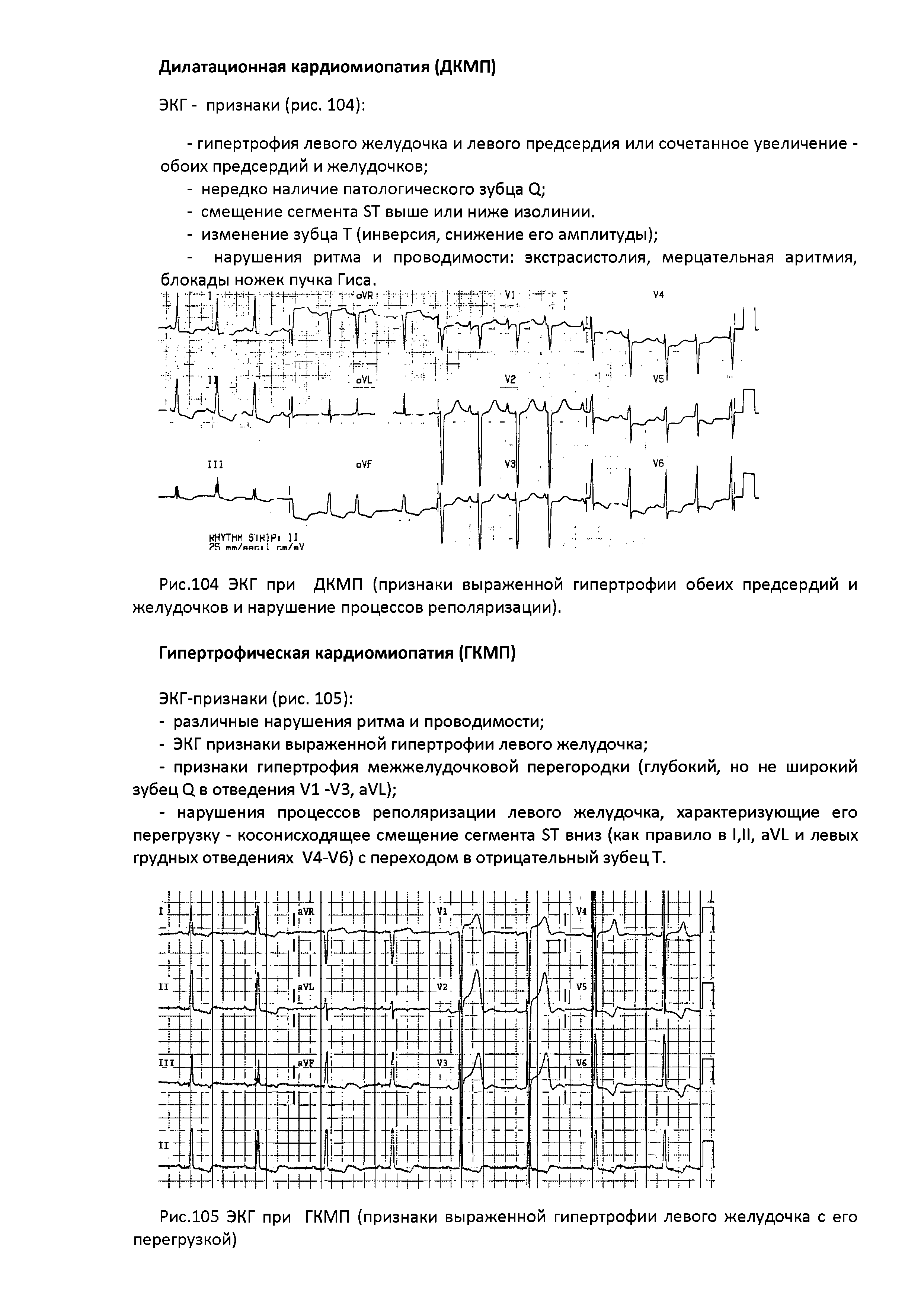 Рис.104 ЭКГ при ДКМП (признаки выраженной гипертрофии обеих предсердий и желудочков и нарушение процессов реполяризации).