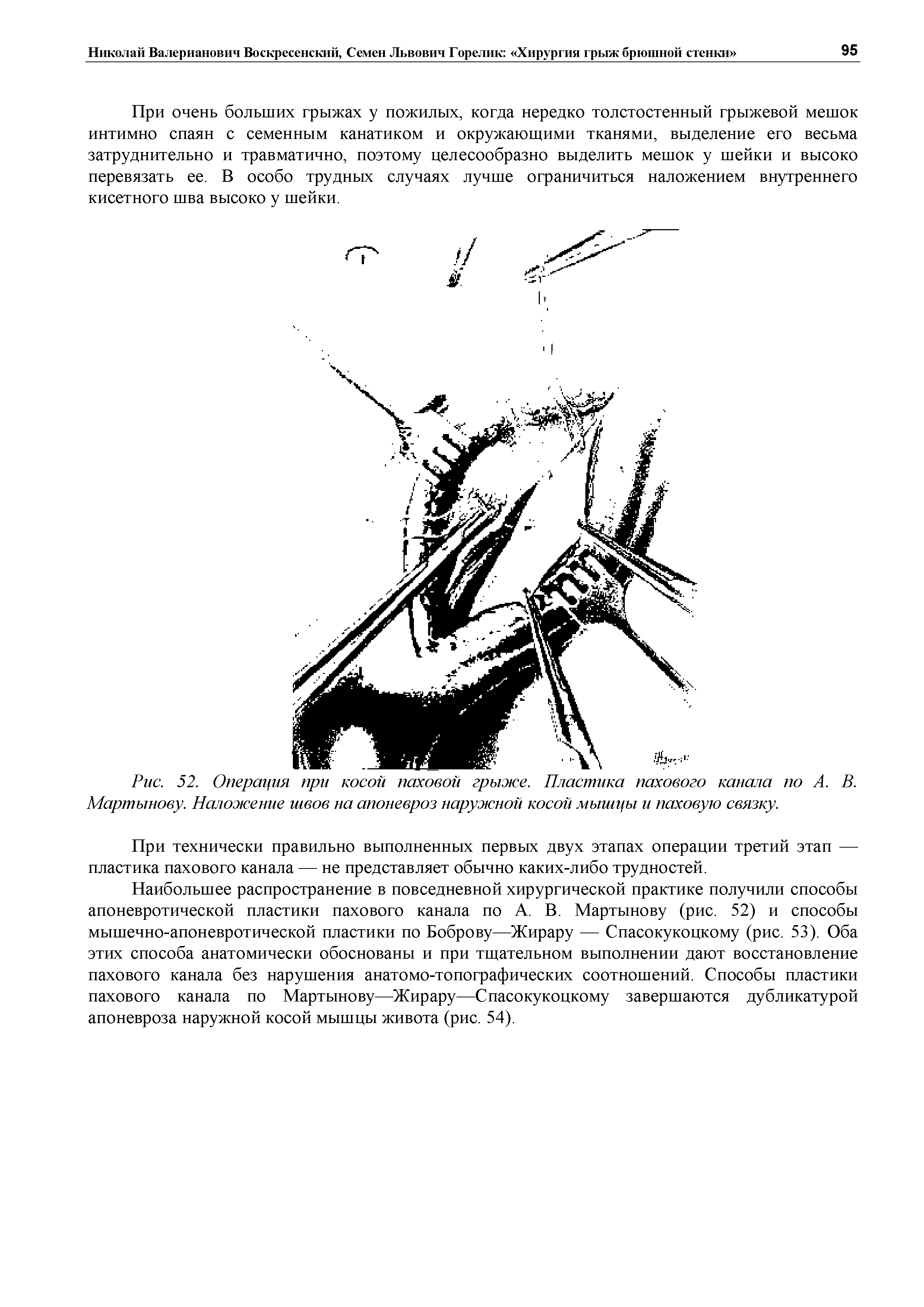 Рис. 52. Операция при косой паховой грыже. Пластика пахового канала по А. В. Мартынову. Наложение швов на апоневроз наружной косой мышцы и паховую связку.