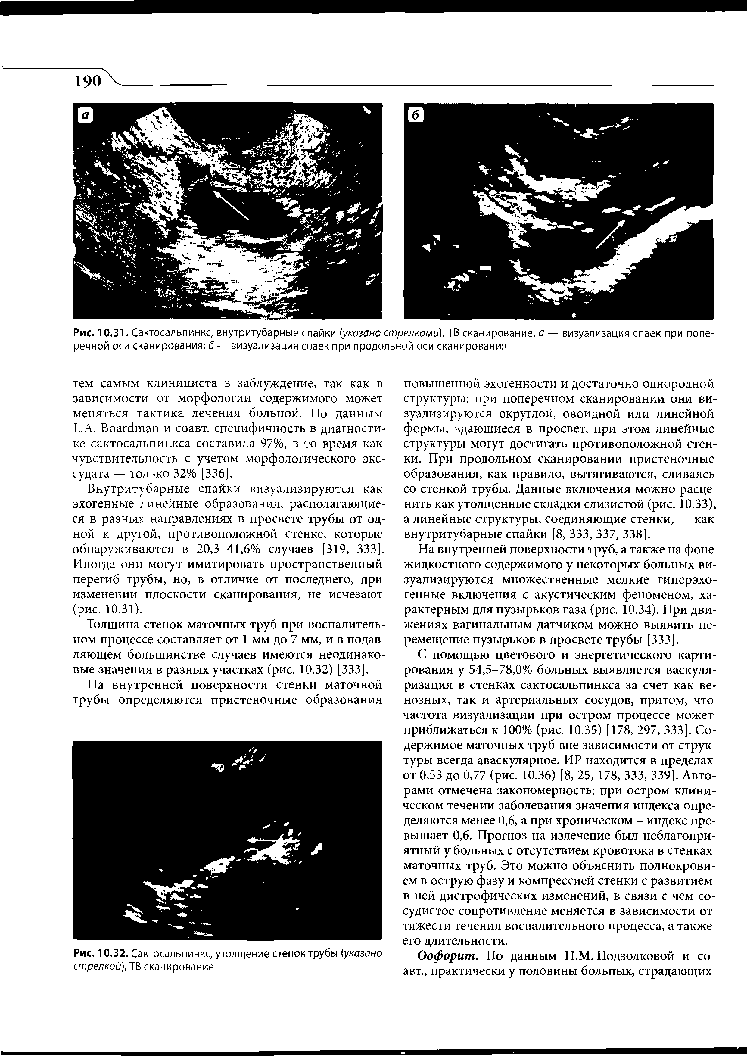 Рис. 10.31. Сактосальпинкс, внутритубарные спайки (указано стрелками), ТВ сканирование, а — визуализация спаек при поперечной оси сканирования б— визуализация спаек при продольной оси сканирования...