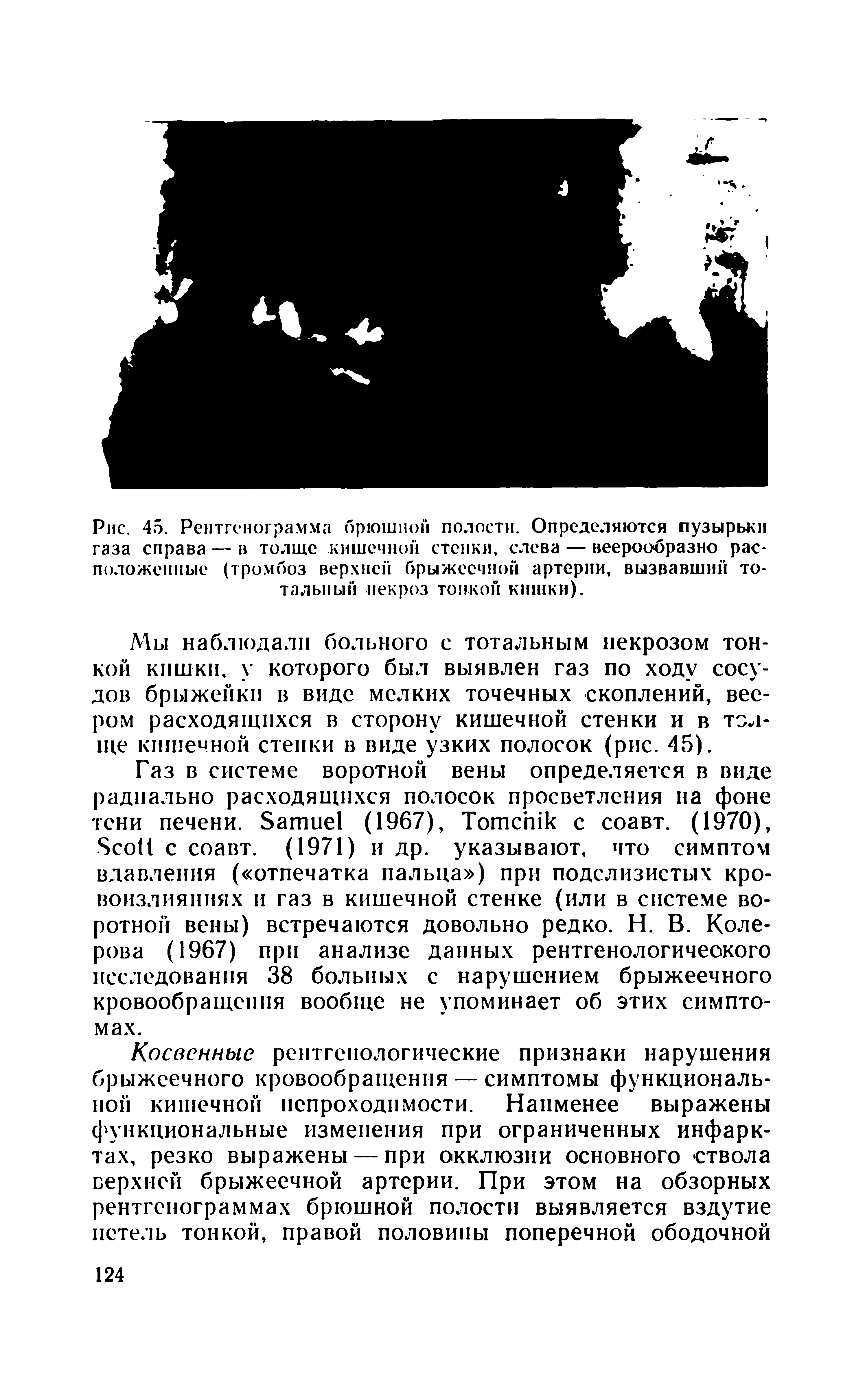 Рис. 45. Рентгенограмма брюшной полости. Определяются пузырьки газа справа — и толще кишечной стенки, слева — веерообразно расположенные (тромбоз верхней брыжеечной артерии, вызвавший тотальный некроз тонкой кишки).