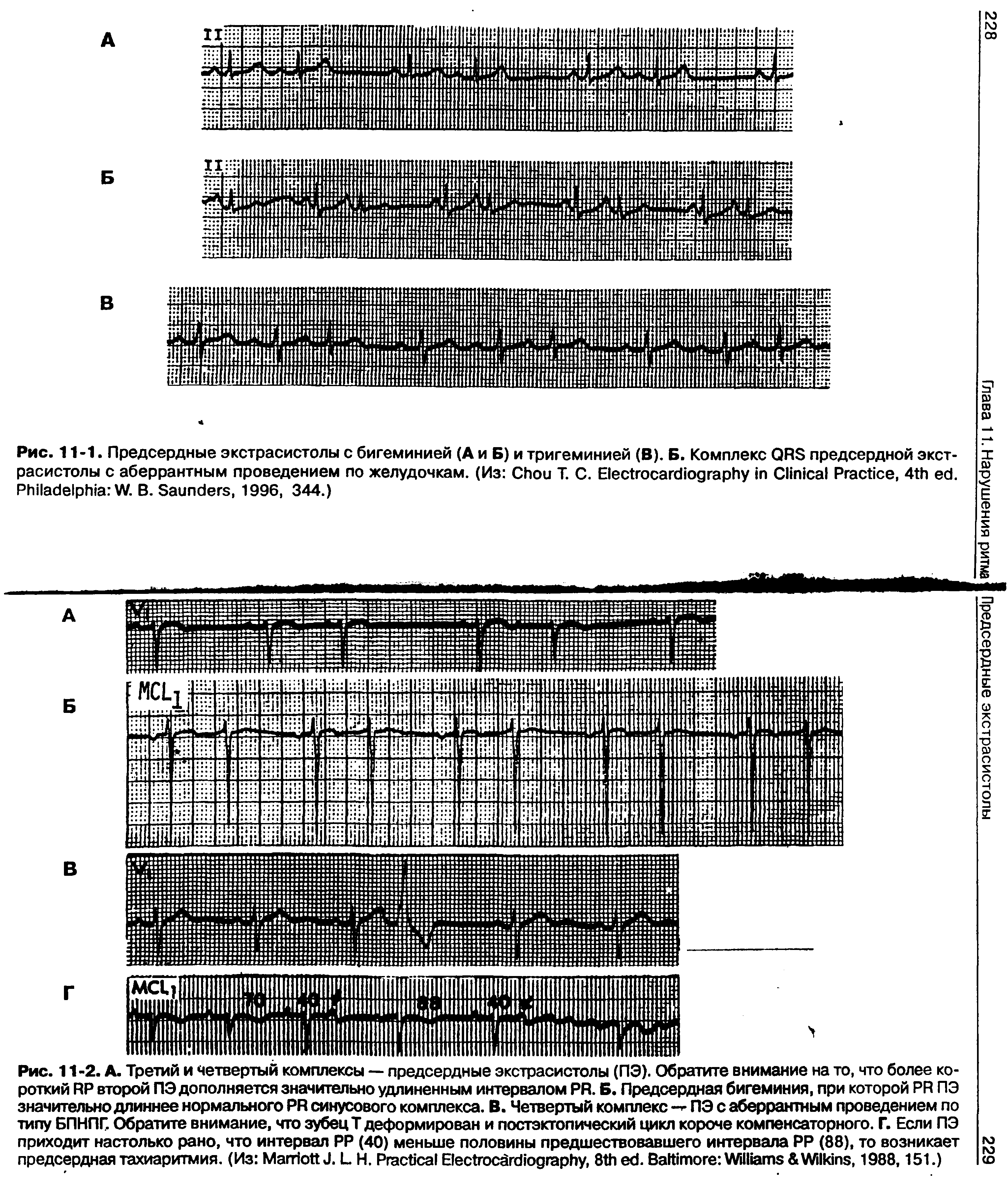 Рис. 11-1. Предсердные экстрасистолы с бигеминией (А и Б) и тригеминией (В). Б. Комплекс QRS предсердной экстрасистолы с аберрантным проведением по желудочкам. (Из C Т. С. E C P , 4 . P W. B. S , 1996, 344.)...