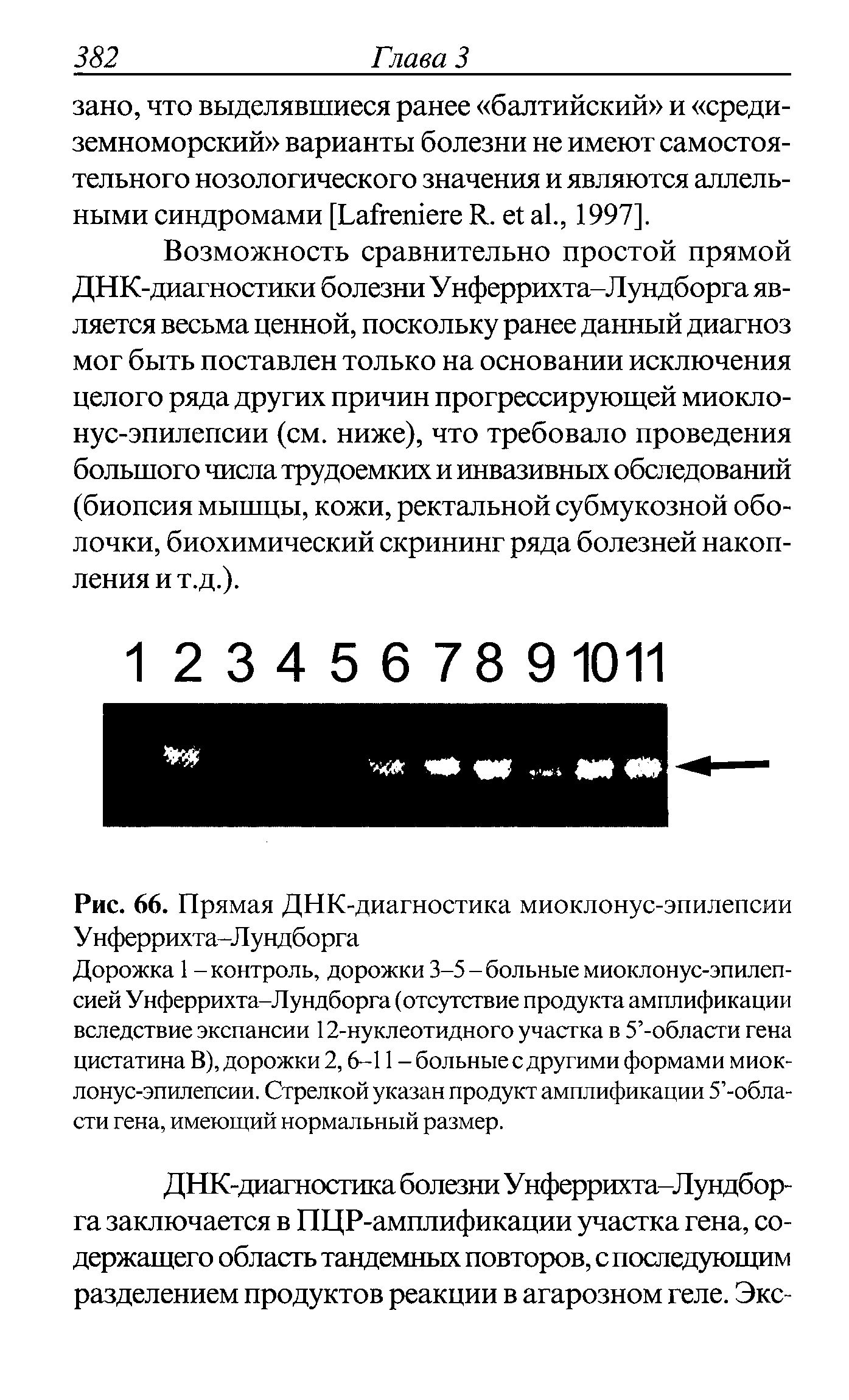 Рис. 66. Прямая ДНК-диагностика миоклонус-эпилепсии Унферрихта-Лундборга...