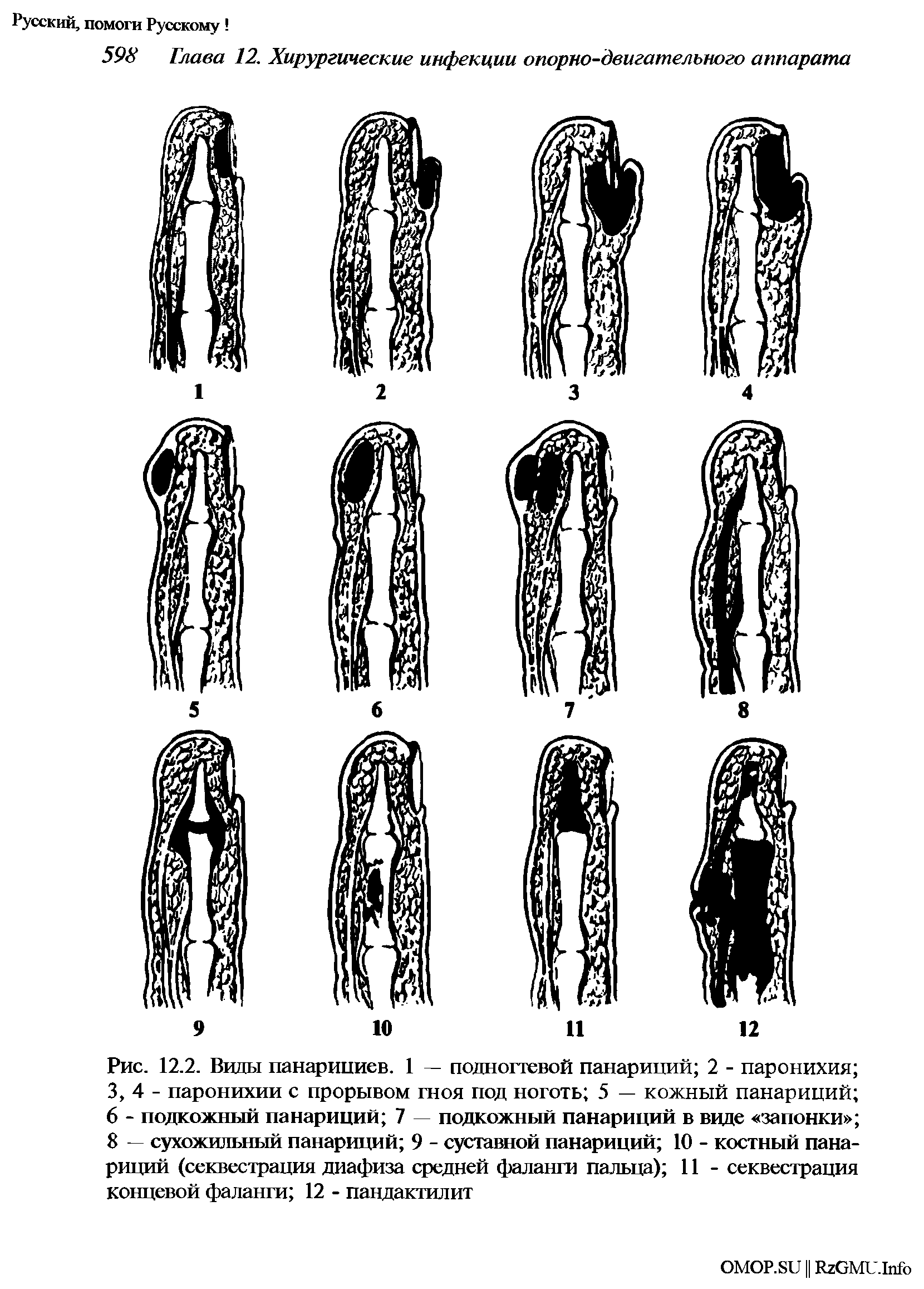 Рис. 12.2. Виды панарициев. 1 — подногтевой панариций 2 - паронихия 3, 4 - паронихии с прорывом гноя под ноготь 5 — кожный панариций 6 - подкожный панариций 7 подкожный панариций в виде запонки 8 - сухожильный панариций 9 - суставной панариций 10 - костный панариций (секвестрация диафиза средней фаланги пальца) 11 - секвестрация концевой фаланги 12 - пандактилит...