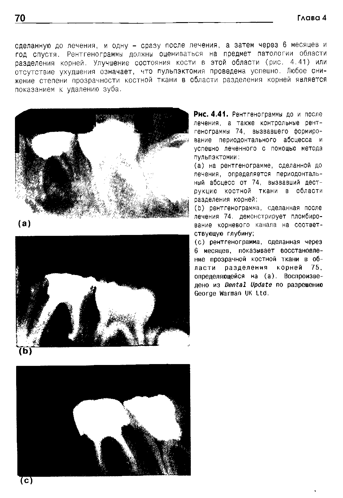 Рис. 4.41. Рентгенограммы до и после лечения, а также контрольные рентгенограммы 74, вызвавшего формирование периодонтального абсцесса и успешно леченного с помощью метода пульпэктомии ...
