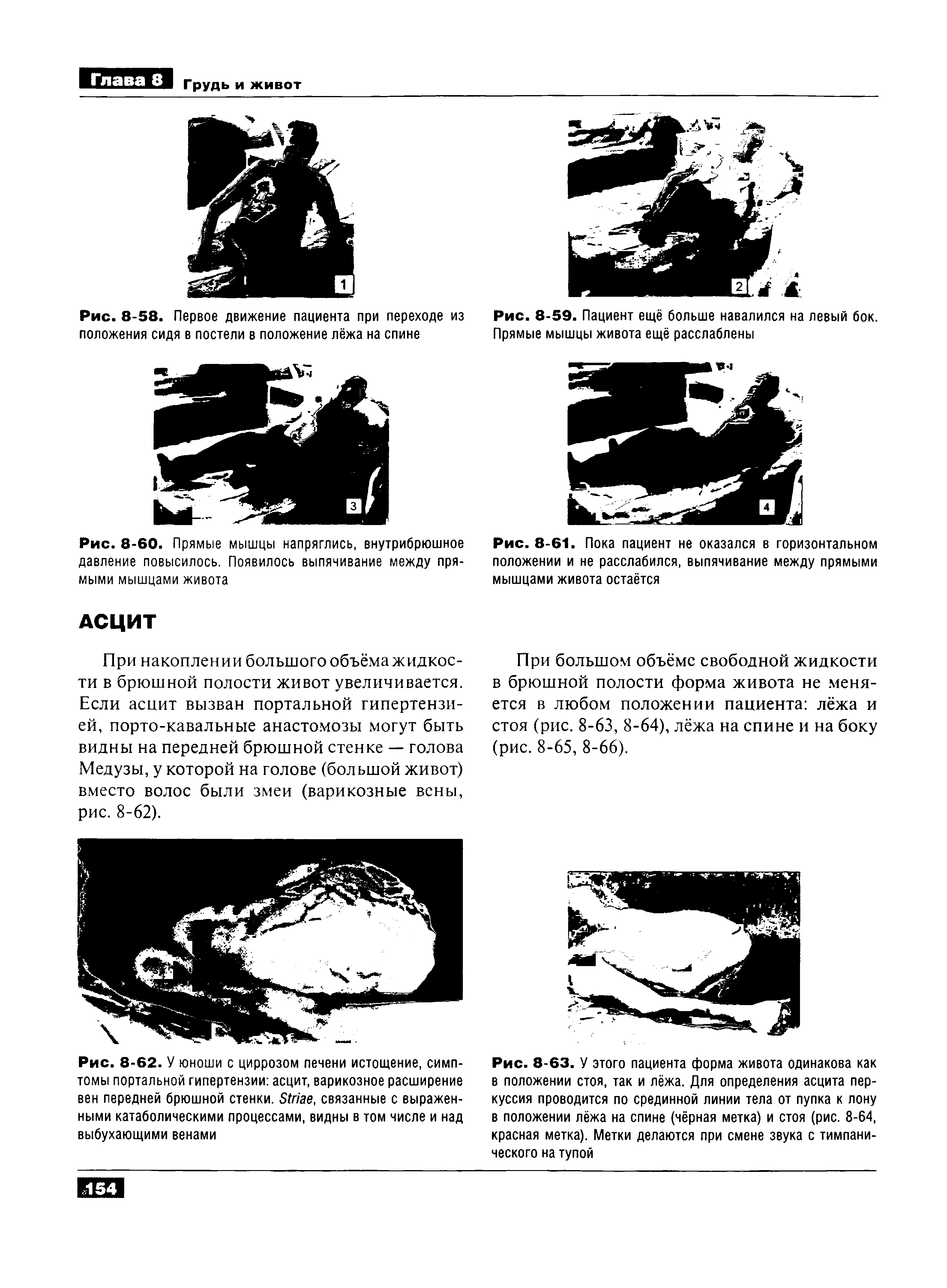 Рис. 8-62. У юноши с циррозом печени истощение, симптомы портальной гипертензии асцит, варикозное расширение вен передней брюшной стенки. S , связанные с выраженными катаболическими процессами, видны в том числе и над выбухающими венами...