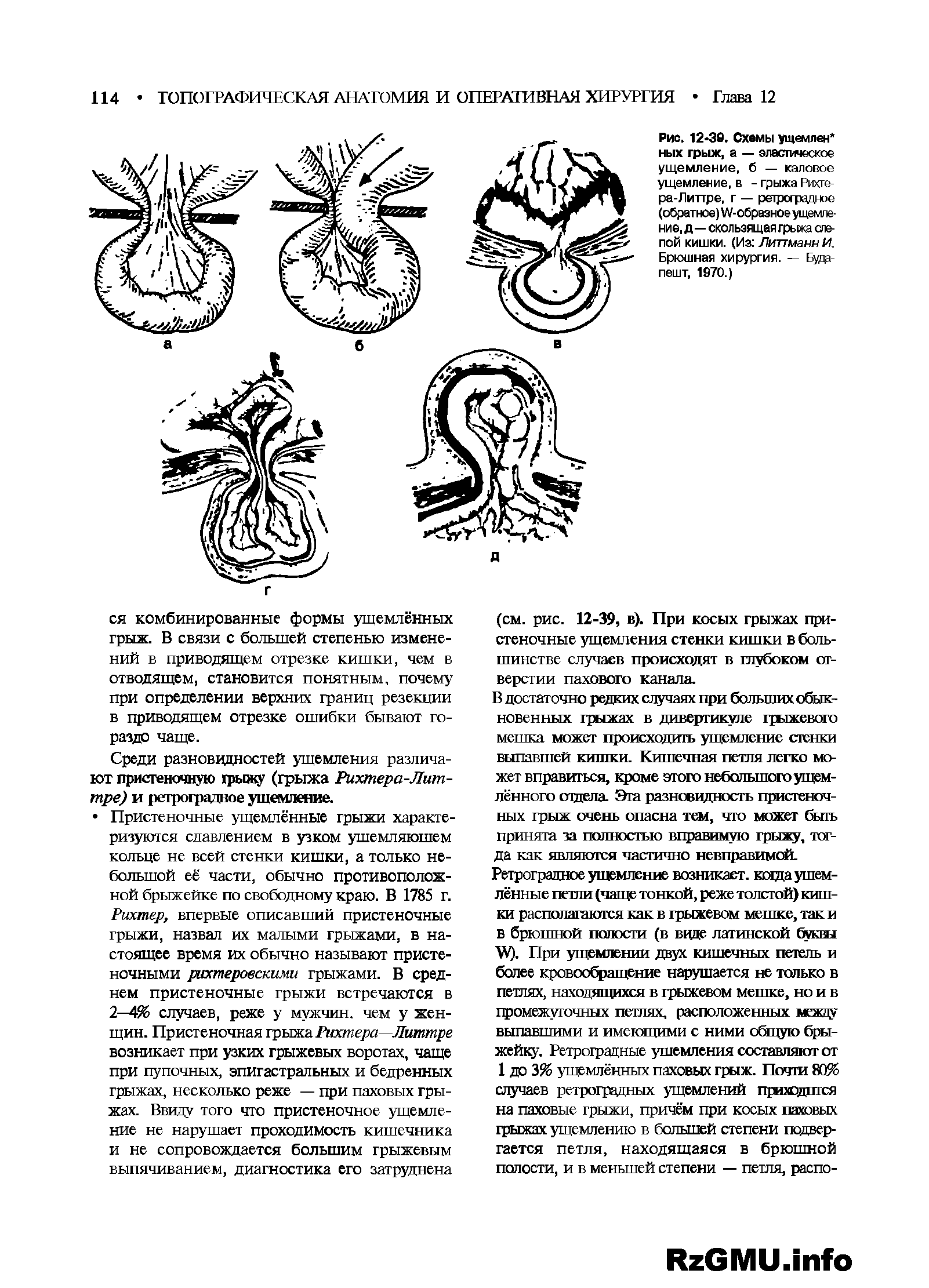 Рис. 12 36. Схемы ущемлен ных грыж, а — эластическое ущемление, б — каловое ущемление, в - грыжа Рихге-ра-Литтре, г — ретроградное (обратное) УУ-образное ущемление, д— скользящая грьсжа слепой кишки. (Из Литгманн И. Брюшная хирургия. — Будапешт, 1970.)...