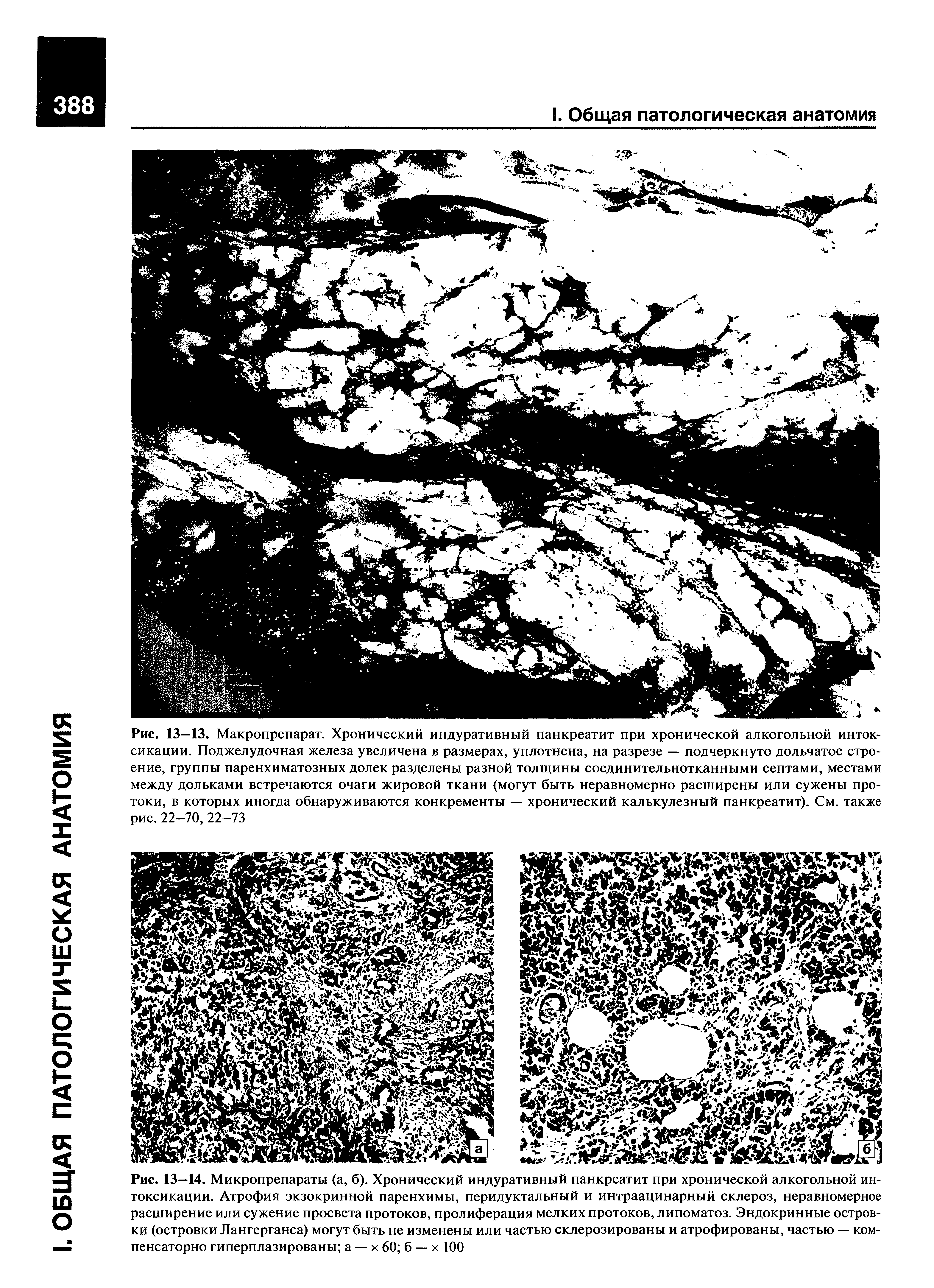 Рис. 13—14. Микропрепараты (а, б). Хронический индуративный панкреатит при хронической алкогольной интоксикации. Атрофия экзокринной паренхимы, перидуктальный и интраацинарный склероз, неравномерное расширение или сужение просвета протоков, пролиферация мелких протоков, липоматоз. Эндокринные островки (островки Лангерганса) могут быть не изменены или частью склерозированы и атрофированы, частью — компенсаторно гиперплазированы а — х 60 б — х 100...