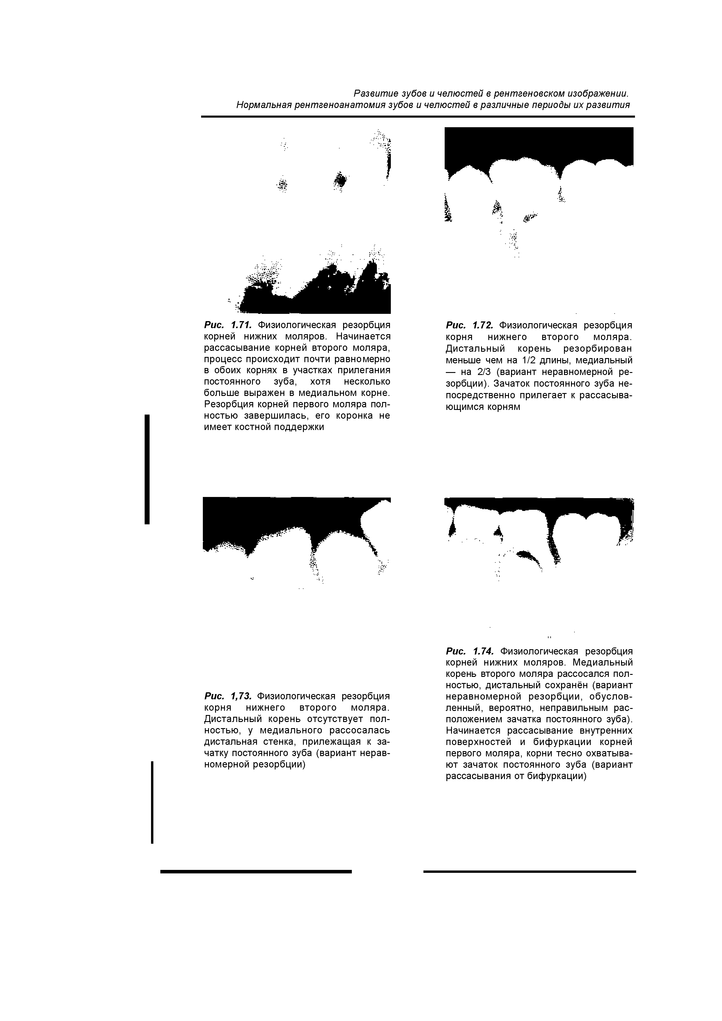 Рис. 1.71. Физиологическая резорбция корней нижних моляров. Начинается рассасывание корней второго моляра, процесс происходит почти равномерно в обоих корнях в участках прилегания постоянного зуба, хотя несколько больше выражен в медиальном корне. Резорбция корней первого моляра пол-...